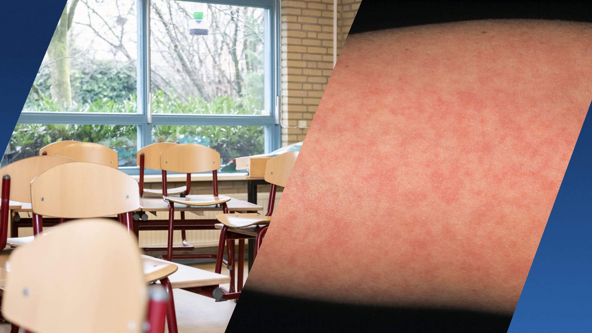 Rust lijkt wedergekeerd: meeste mazelenclusters rond scholen doven uit