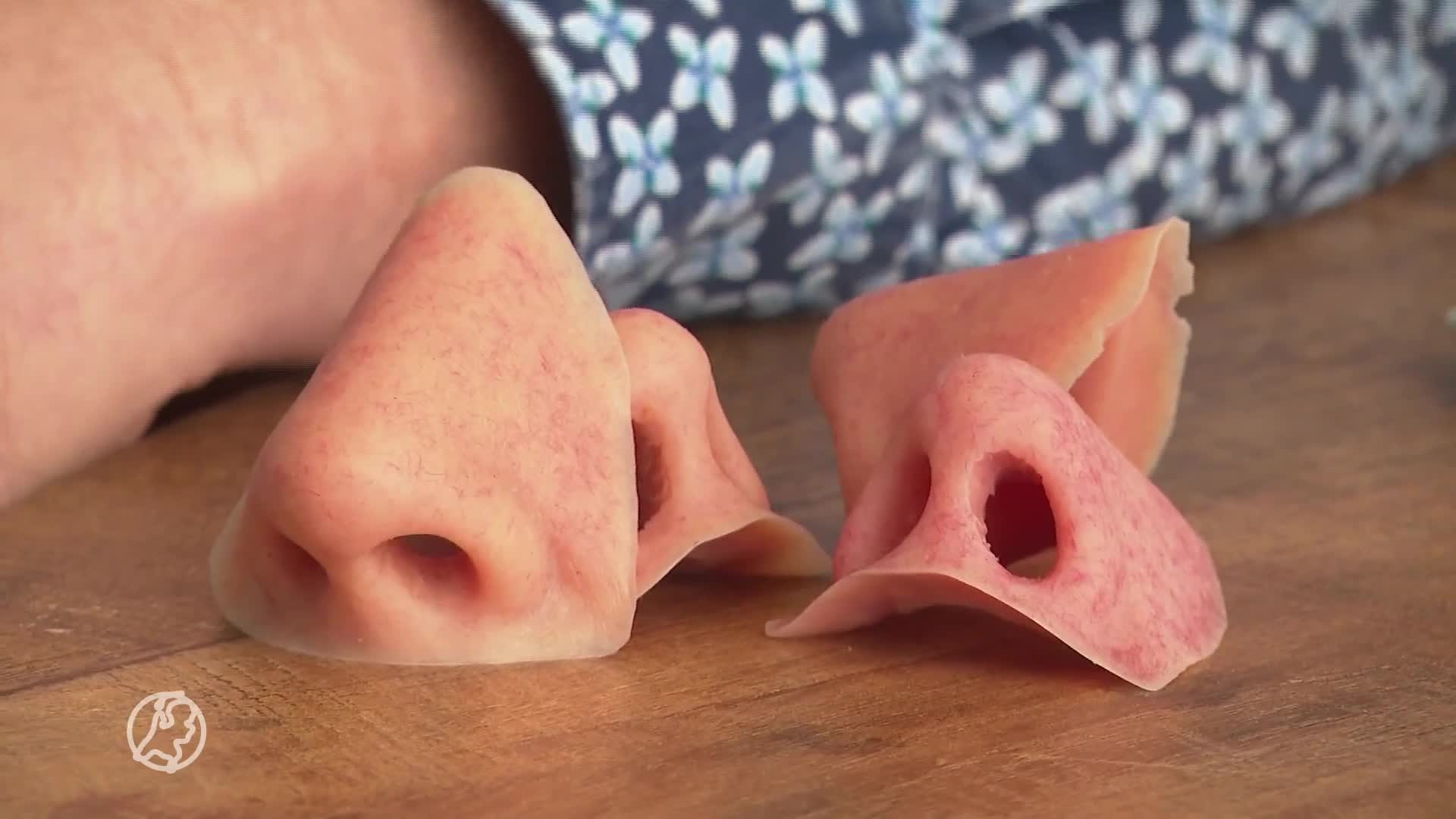 Lotgenoten Dieuwertje weten hoe het is om te leven met neusprothese: 'Rollercoaster'
