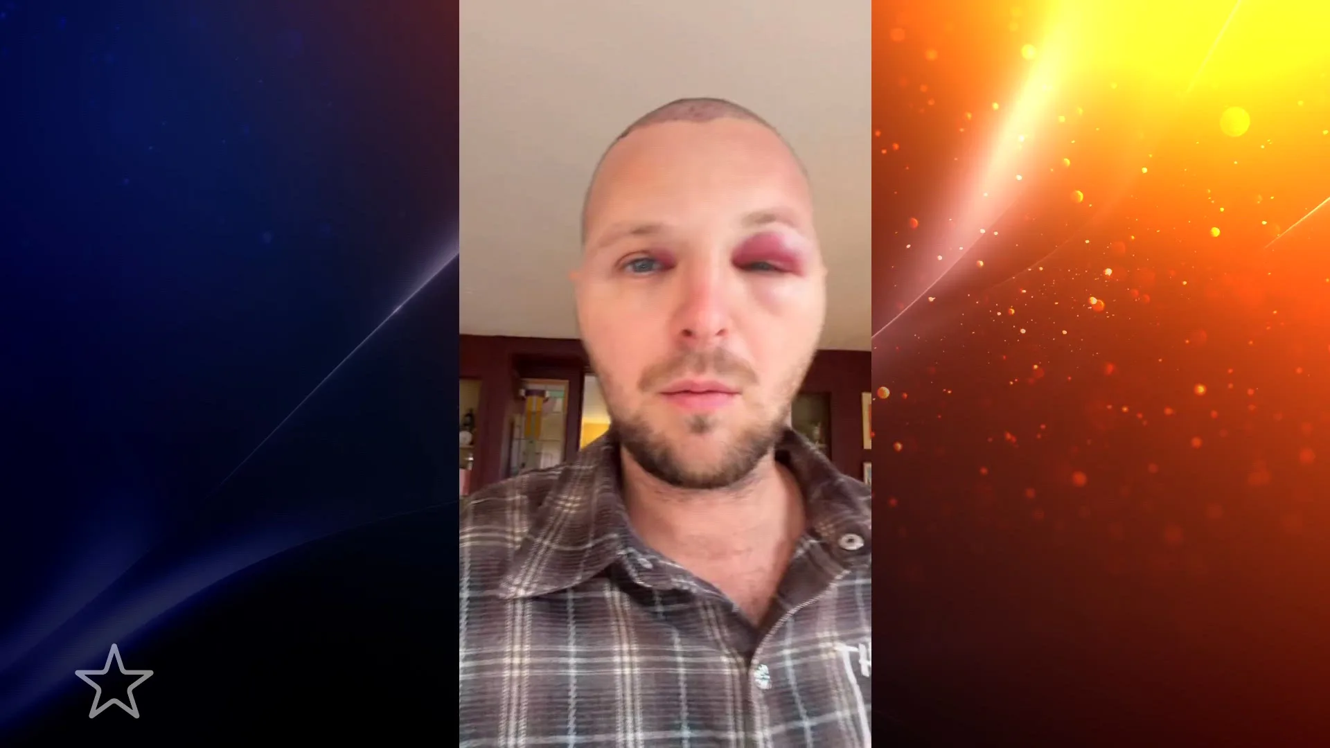 Tim Senders schrikt van uiterlijk na haartransplantatie