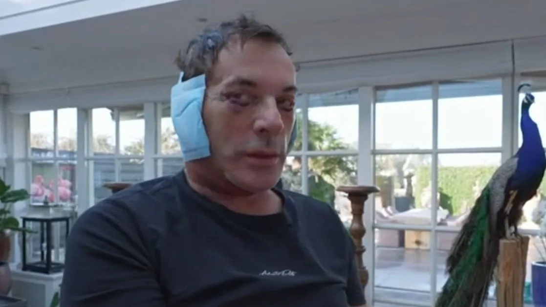 Zó wordt er gereageerd op cosmetische ingreep Gerard Joling