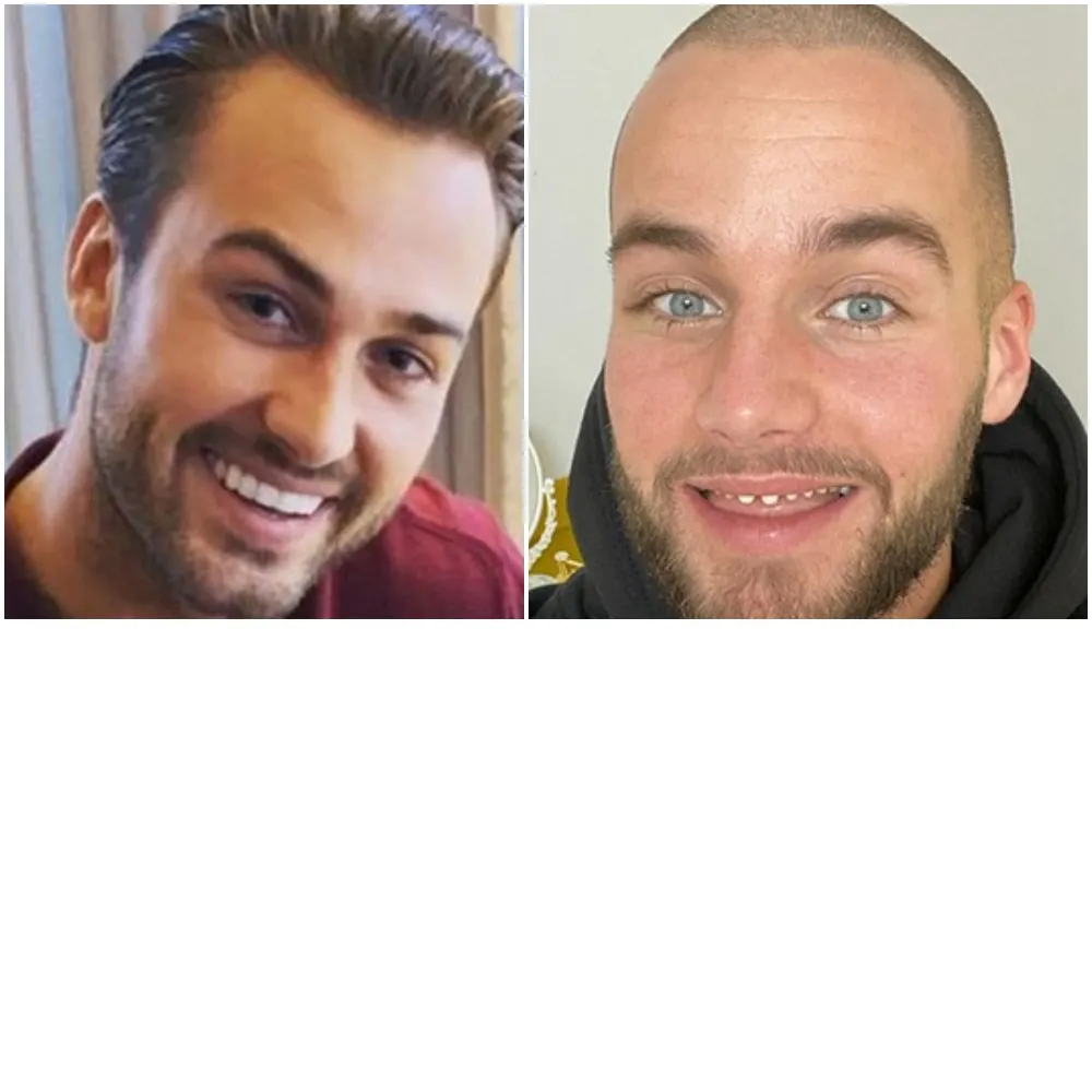 Ook Dave Roelvink laat zichzelf zien zonder neptanden