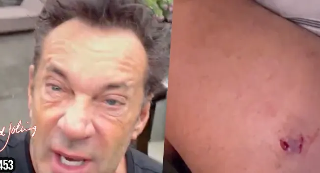 Gerard Joling deelt bloederige beelden na aanval hond