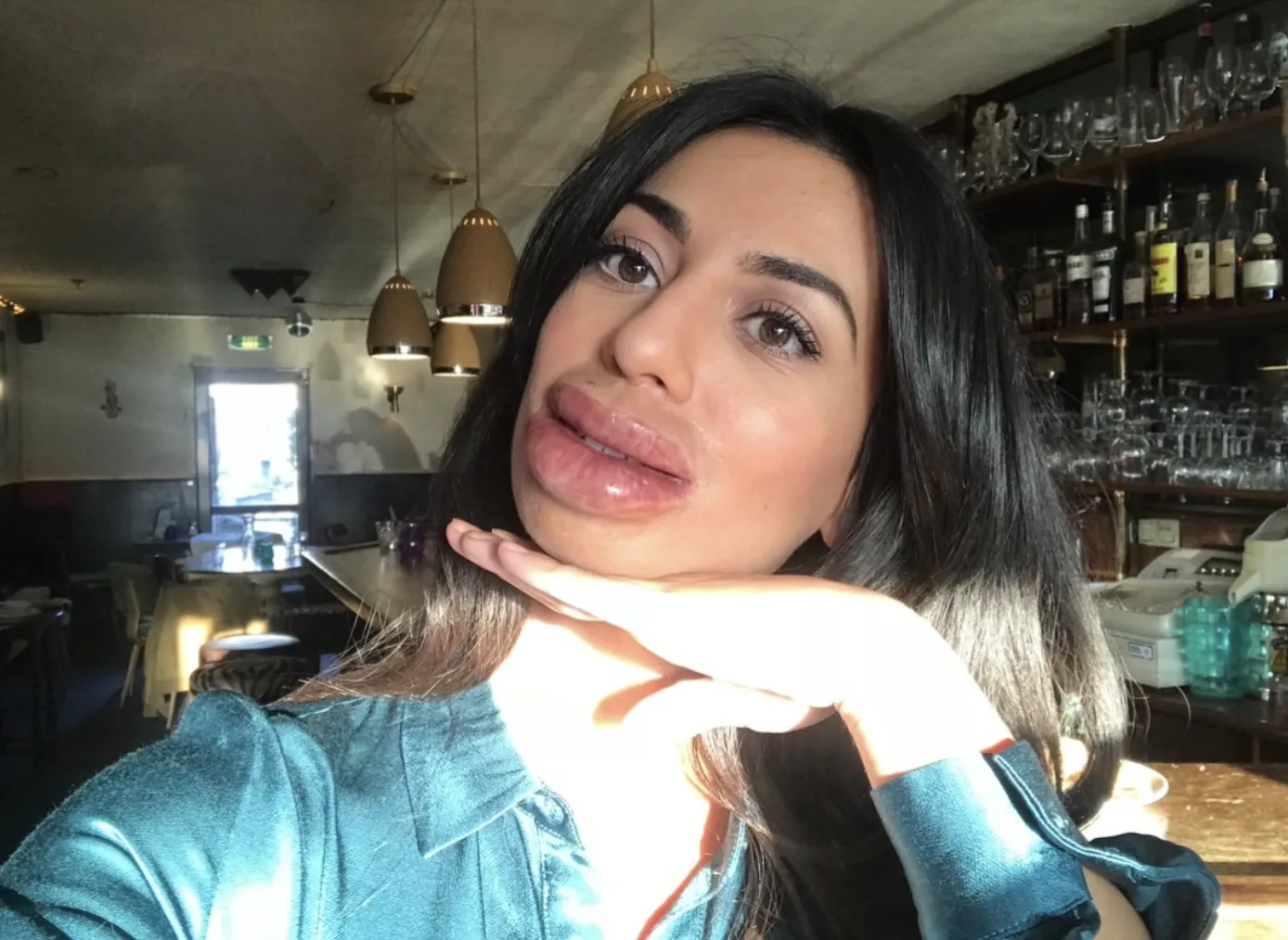 Een lipfillertje te veel voor Hila Noorzai?