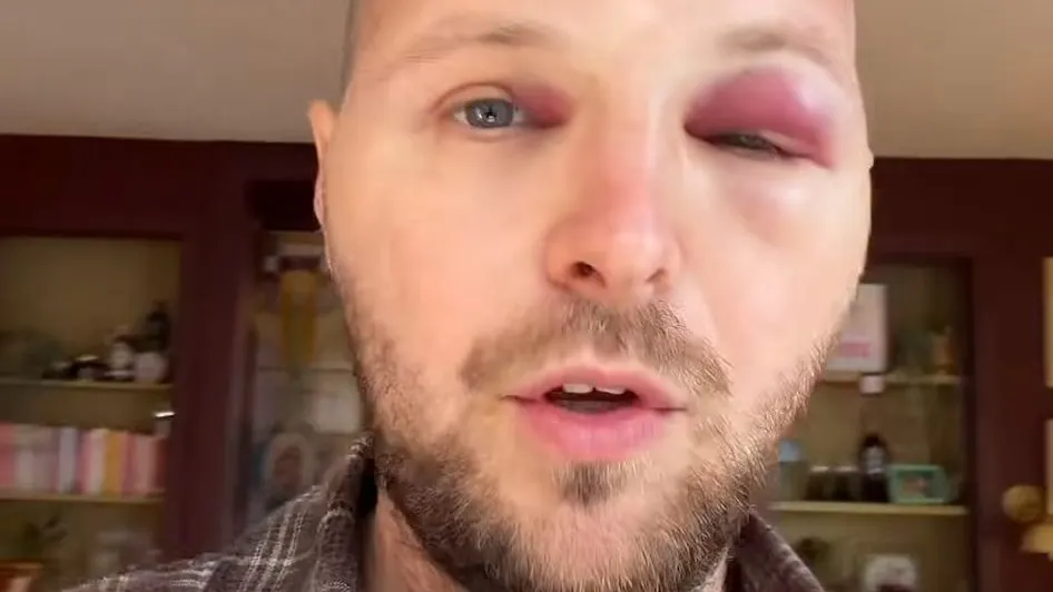 Tim Senders schrikt van uiterlijk na haartransplantatie: 'Is geen filter'