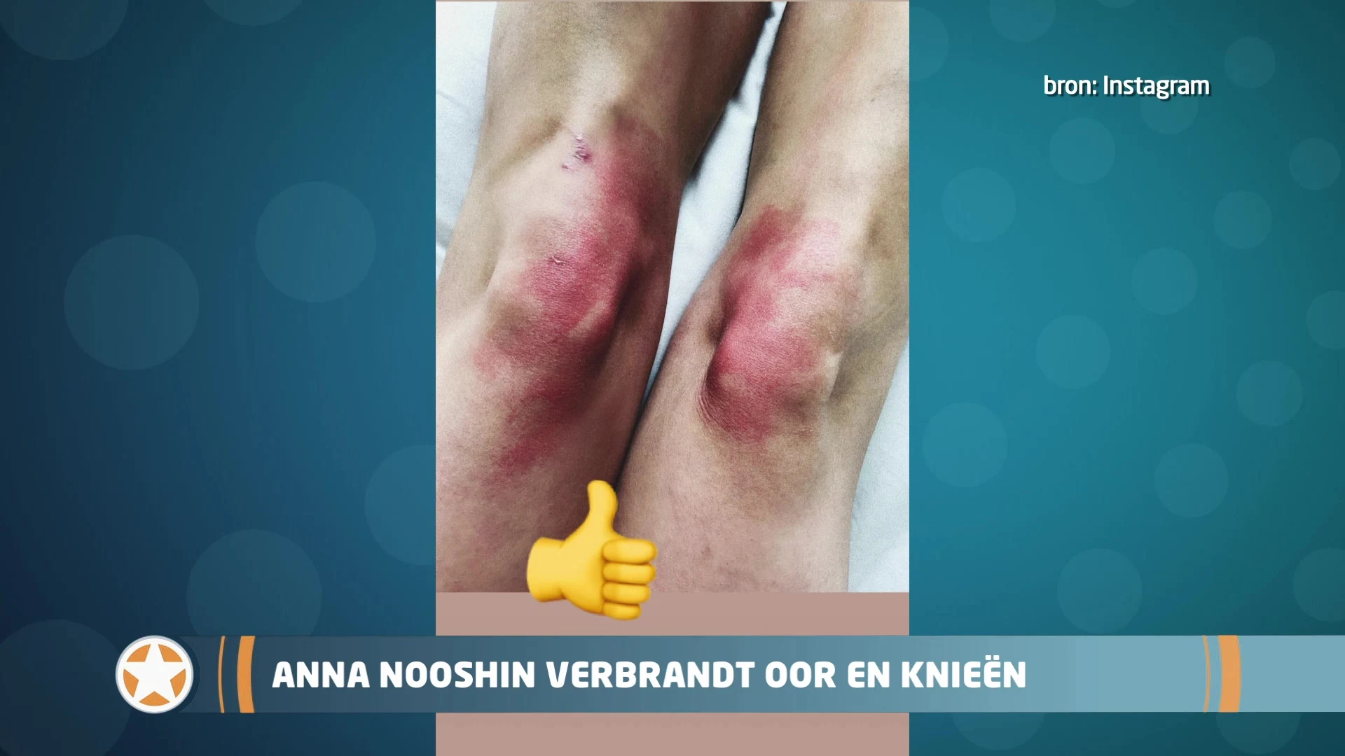 Show Update: Anna Nooshin verbrandt oor en knieën