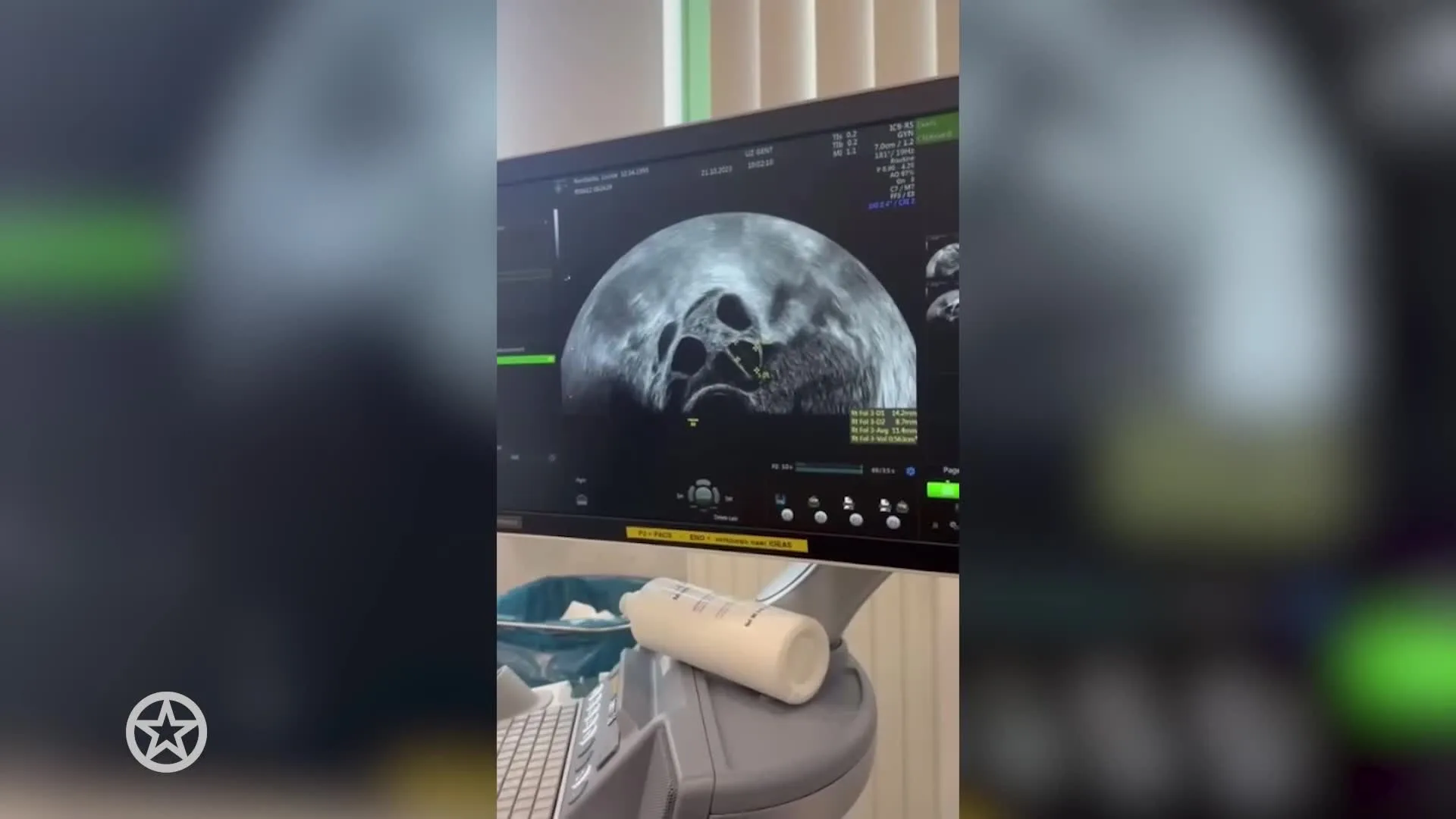 Love Islands Loesje verwacht eerste kindje