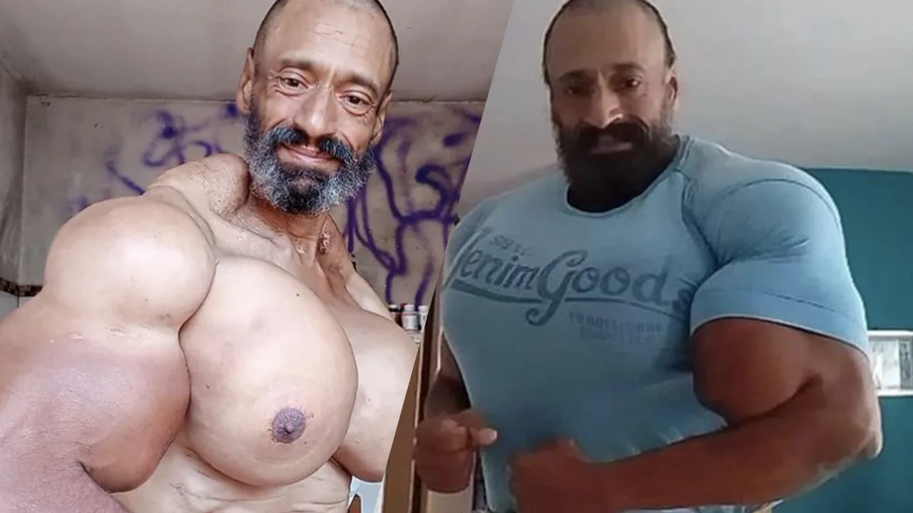 Man die olie in spieren injecteerde overleden op 55-jarige leeftijd