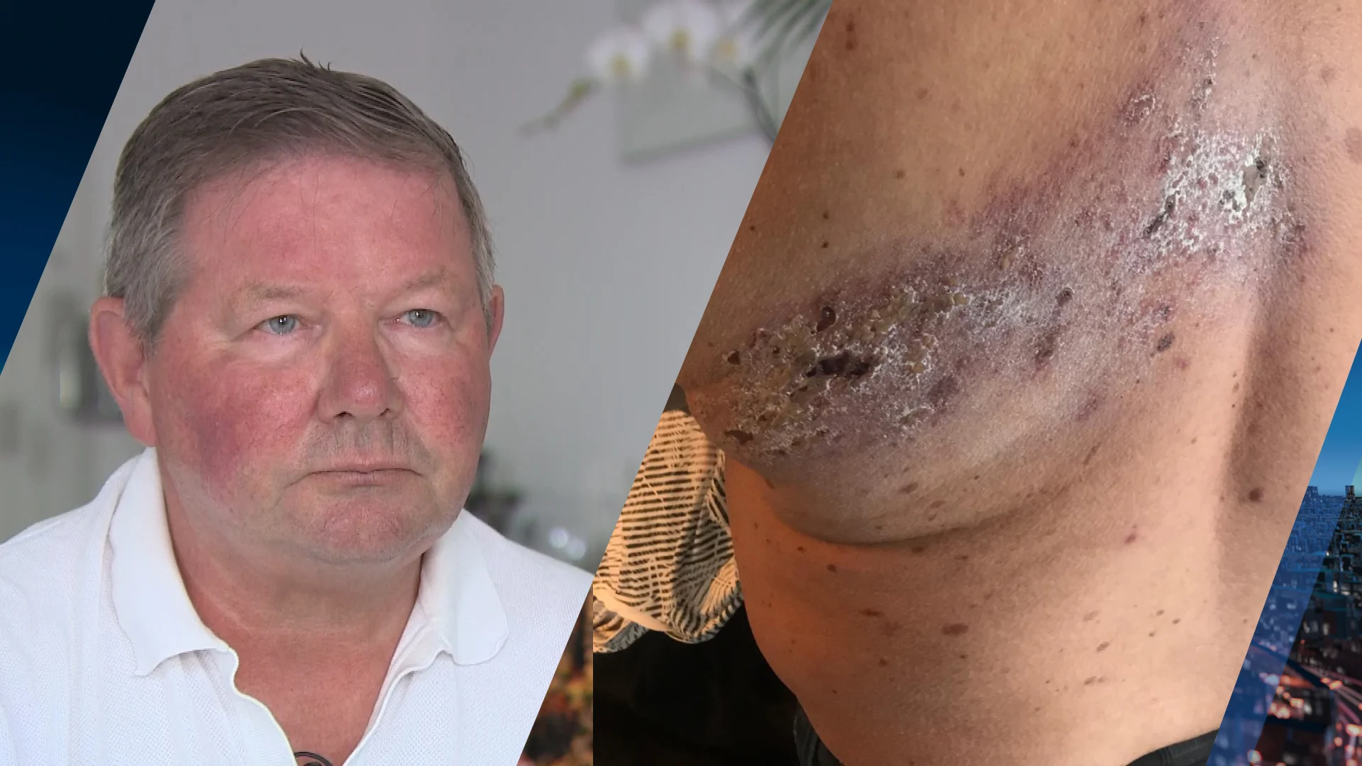 Gordelroos zet leven Klaas op z'n kop: 'Zenuwen afgestorven en elke dag brandende pijn'