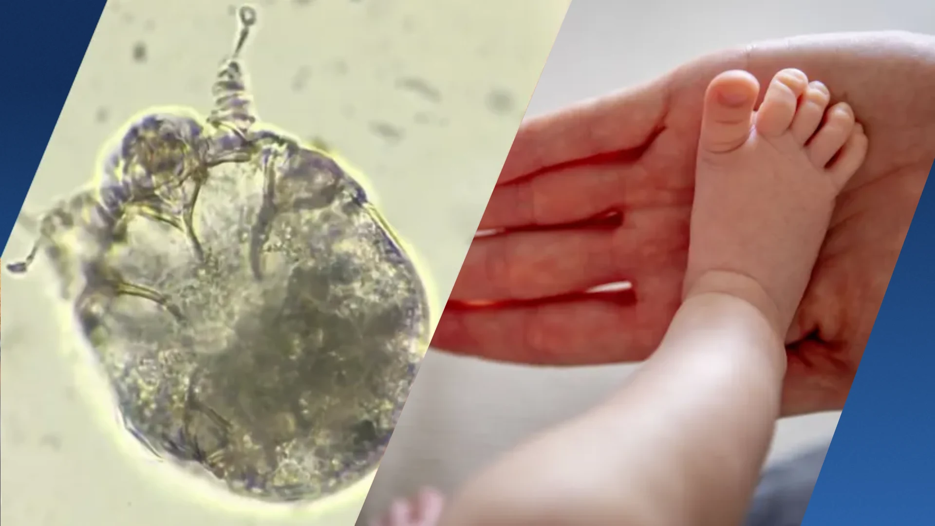 Schurft rukt op: steeds vaker in crèches en verpleeghuizen