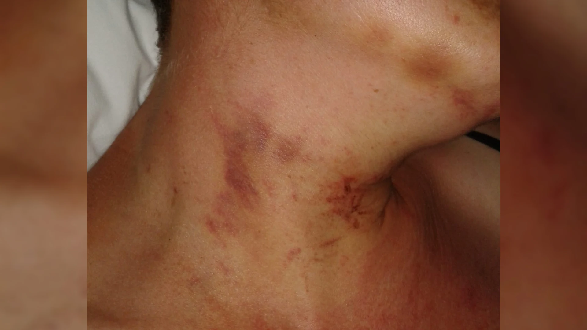 Bijna vermoord en toch geen bewijs: nieuw onderzoek moet wurgpoging aantonen