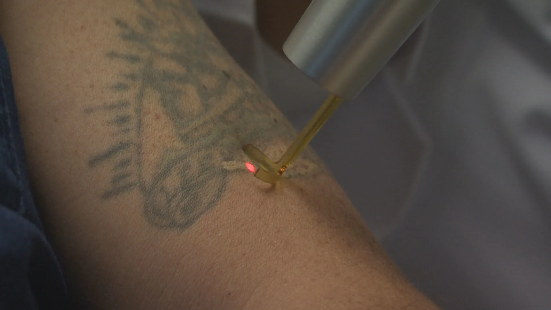 Meldpunt voor slachtoffers van mislukte tattooverwijderingen: 'Het is erg schrijnend'