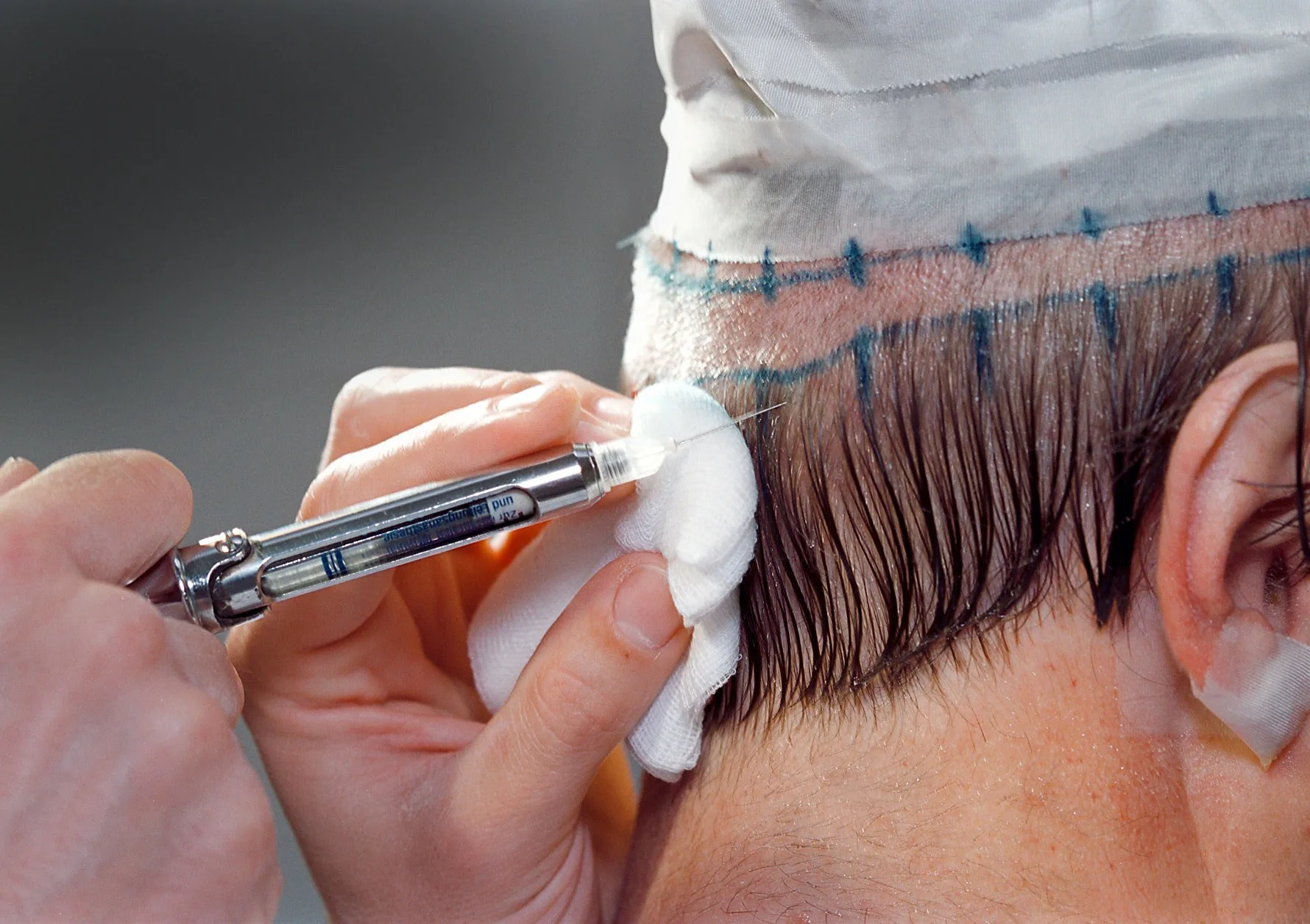 Haartransplantaties populair, maar malafide 'cowboys' in opkomst