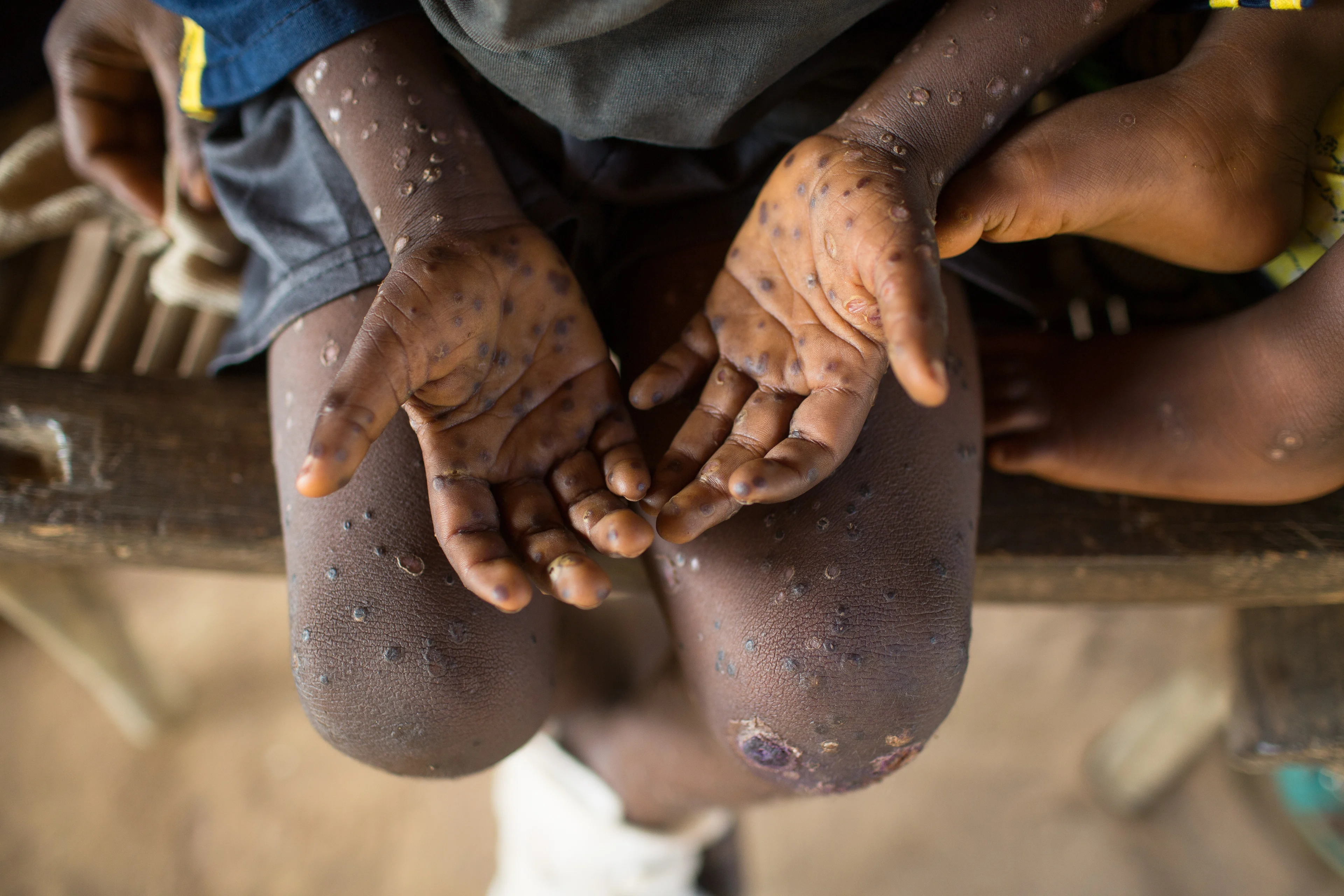 Angst voor apenpokkenvirus? Meerderheid van Nederlanders is (nog) niet bang