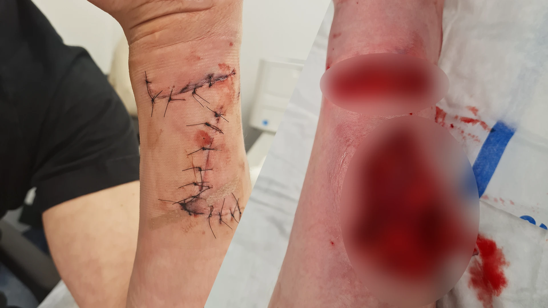 Remko heeft 17 hechtingen na aanval door wild zwijn: 'Ik dacht dat het klaar was'