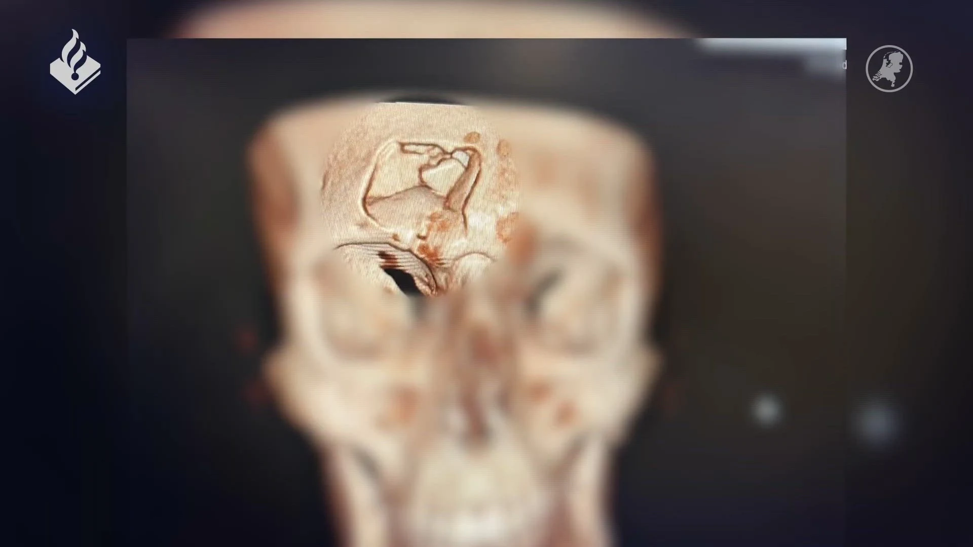 Carnavalsganger slaat gat in schedel van jongen in Den Bosch