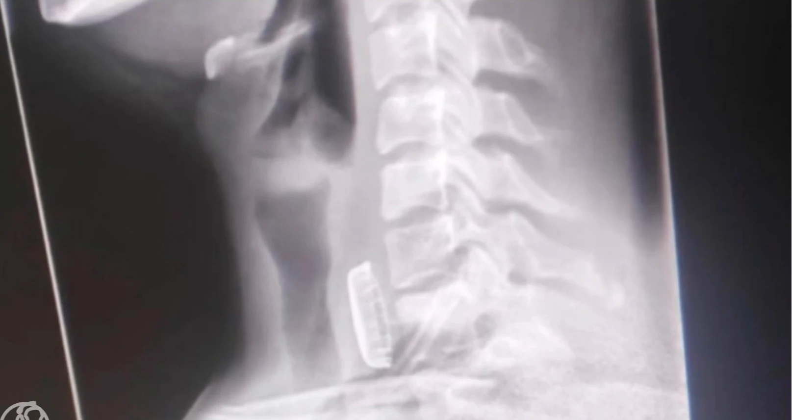 Gronings ziekenhuis waarschuwt voor populair drankspel dopje-dopje: het is levensgevaarlijk