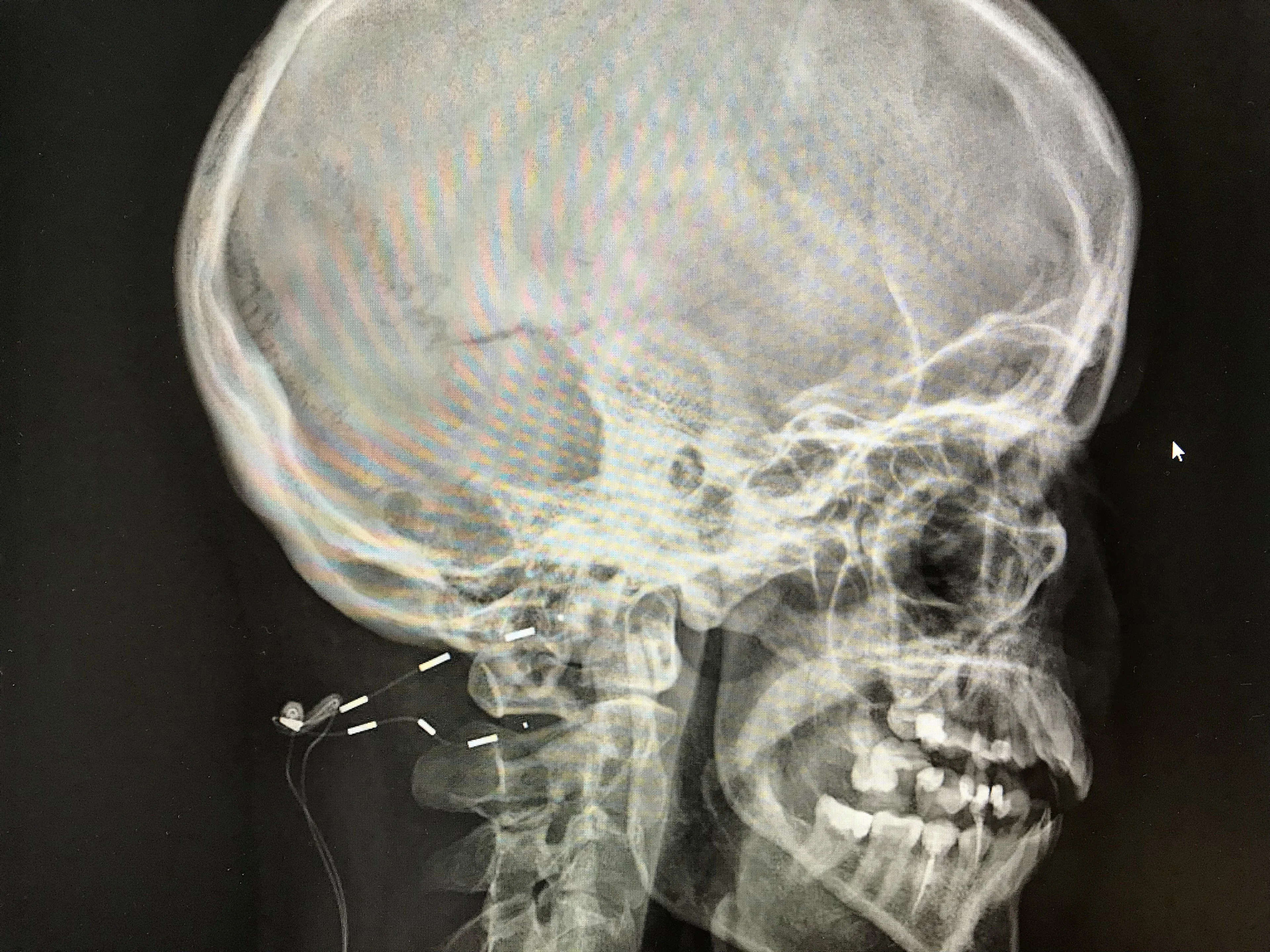 Nieuw apparaatje maakt leven van mensen met 'zelfmoordhoofdpijn' weer leefbaar