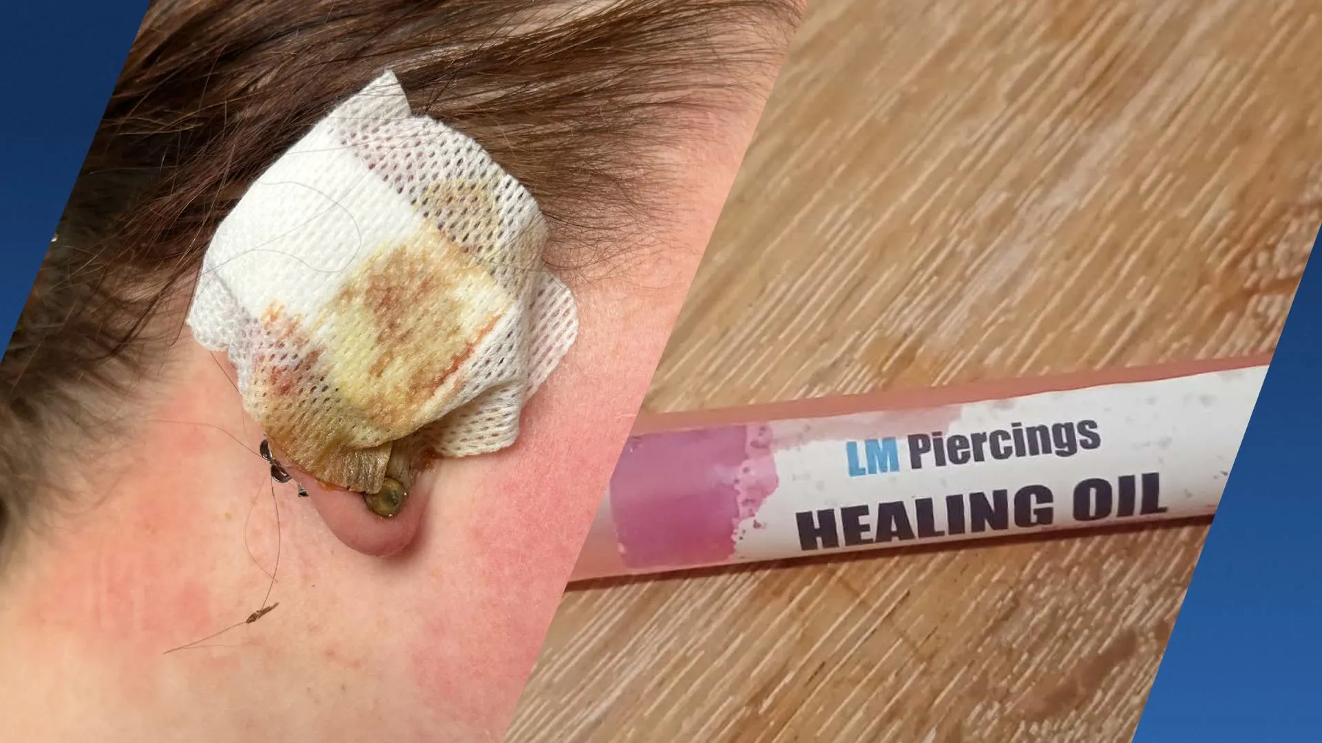 Jolanda loopt bacteriële infectie op na gebruik nazorgspay voor piercings