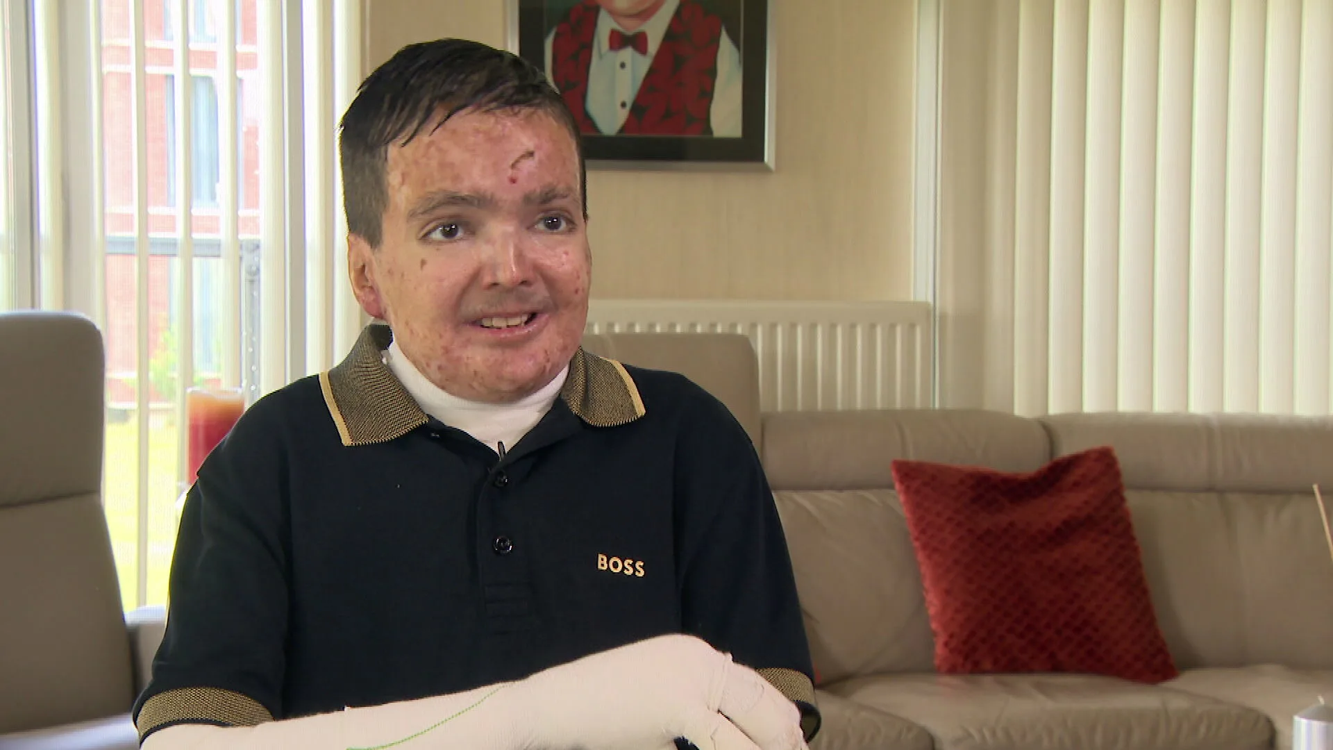 Nieuwe zalf biedt hoop voor Shivan: vlinderziekte beter te behandelen