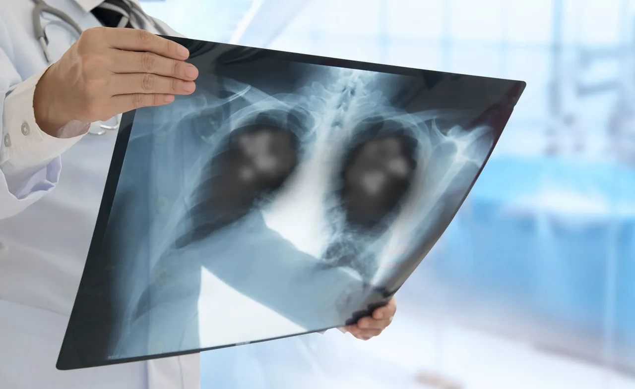 Levens redden met AI: slimme computers kunnen longkanker veel eerder opsporen