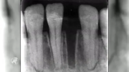 Dave (23) moet een paar tanden missen na nachtelijke hulpactie