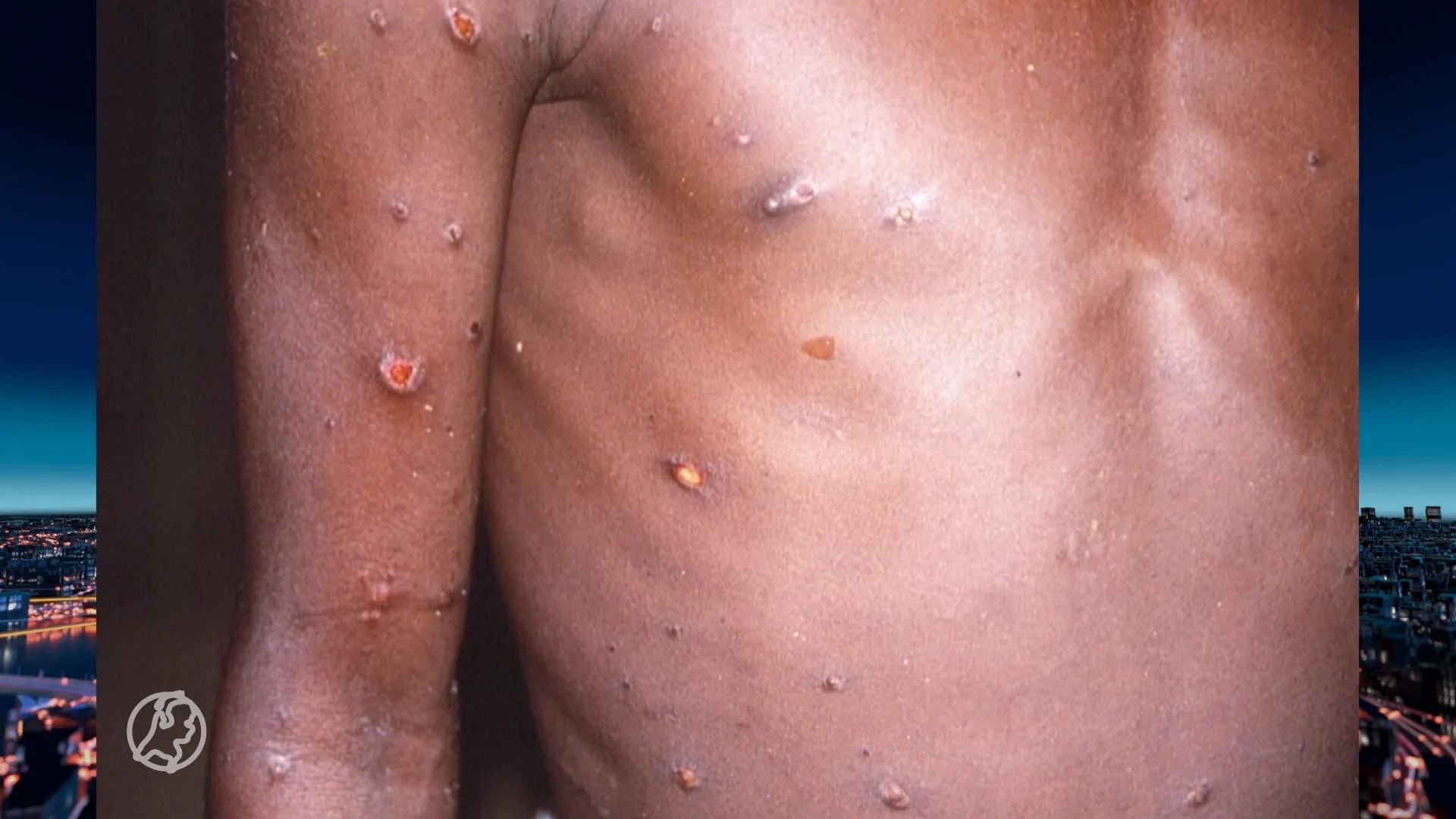 Apenpokkenvirus voor het eerst ook in Nederland vastgesteld