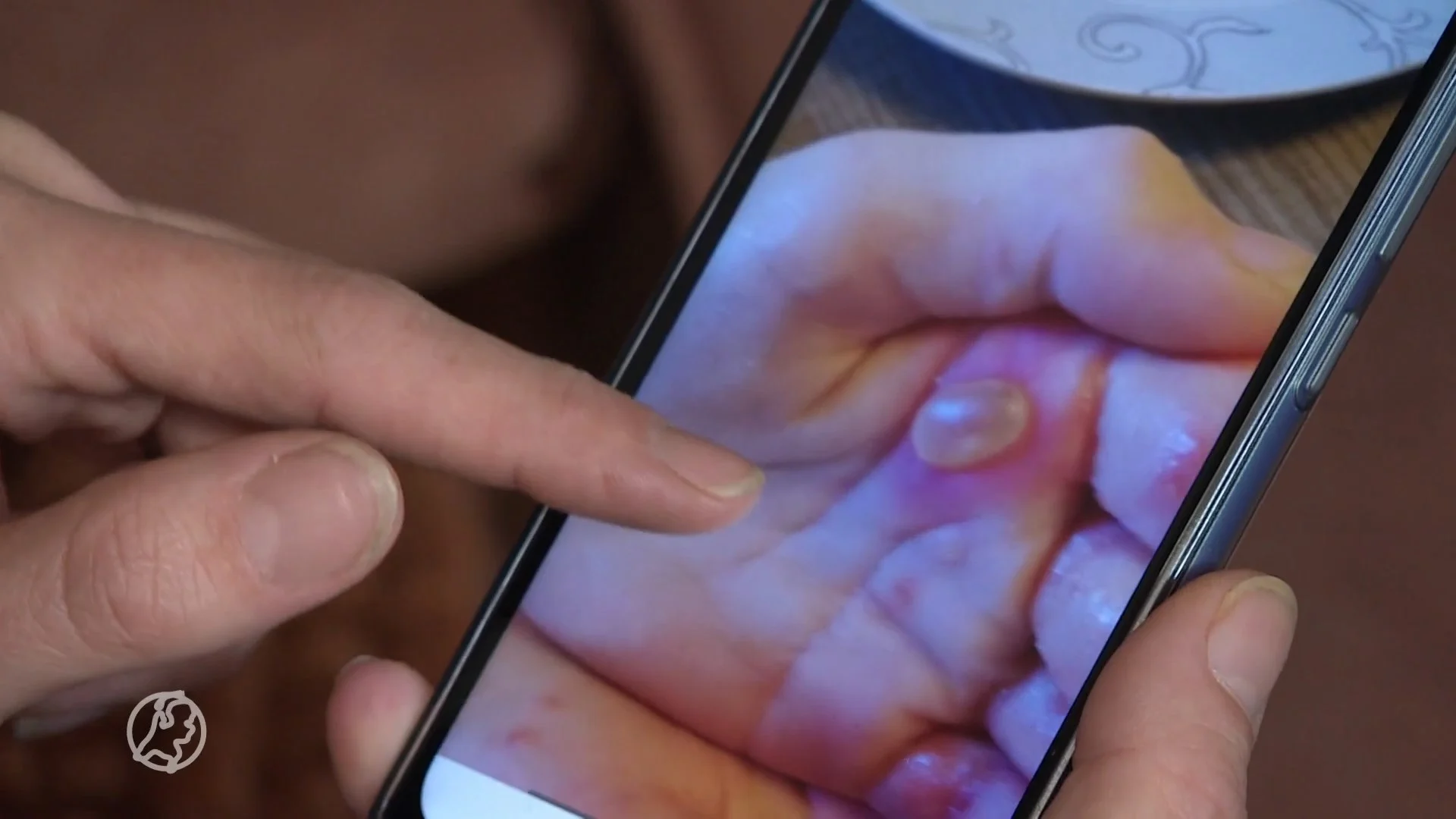 Schurft bezig aan enorme opmars, vrees voor grote uitbraken