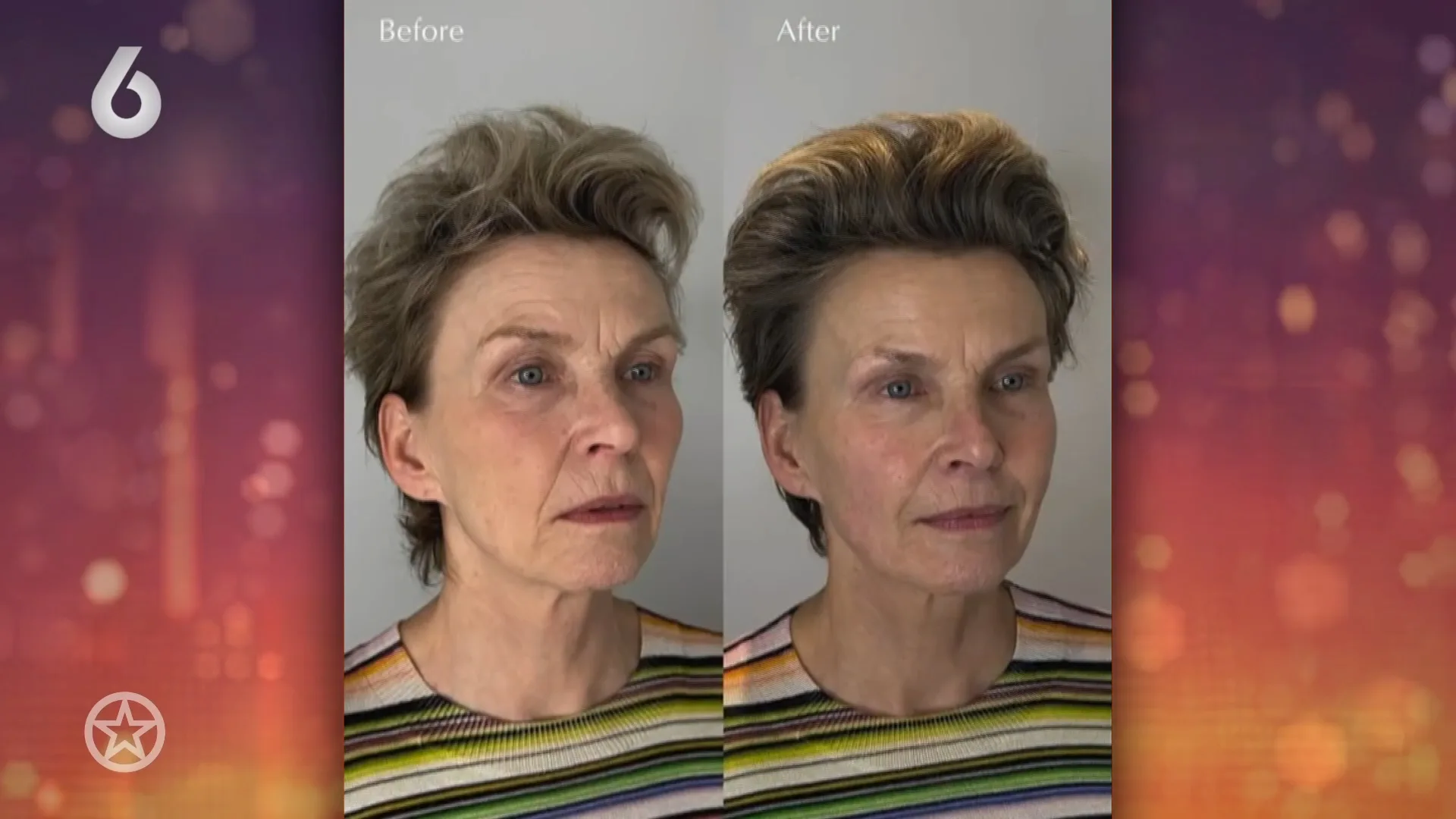 Anita Witzier deed een liquid facelift