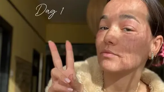 BN'er spreekt zorgen uit over pijnlijke behandeling Bibi Breijman