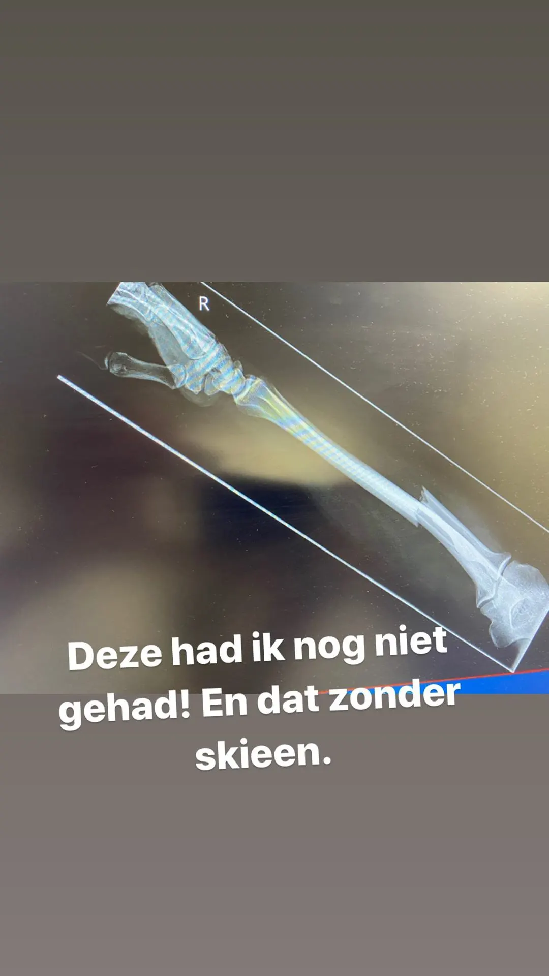 UPDATE: Wolter Kroes moet onder het mes