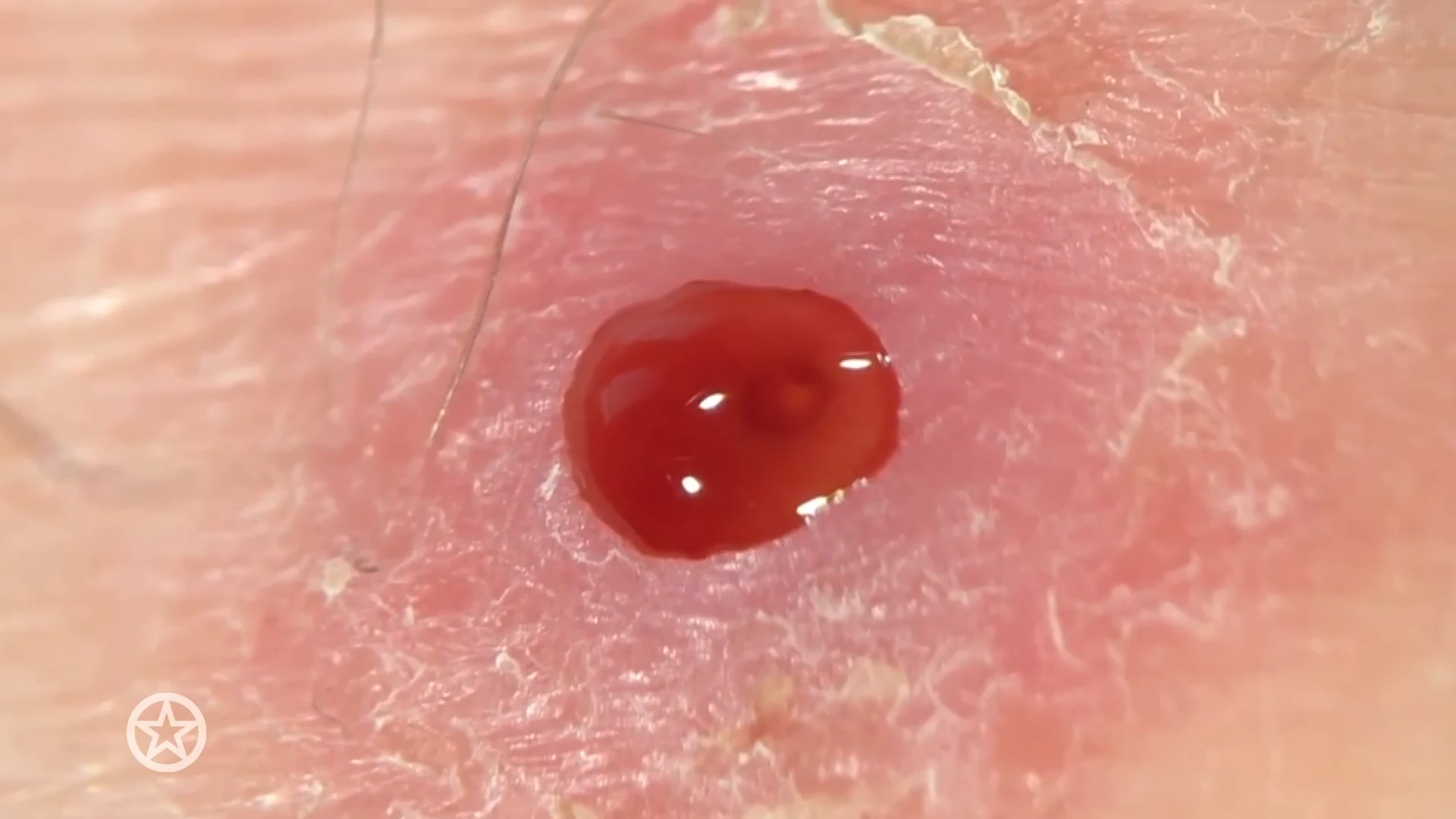 Freek Vonk geeft 'zeer ranzige' ontsteking-update