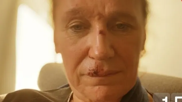 Renée Fokker met beide armen in het gips na aanrijding