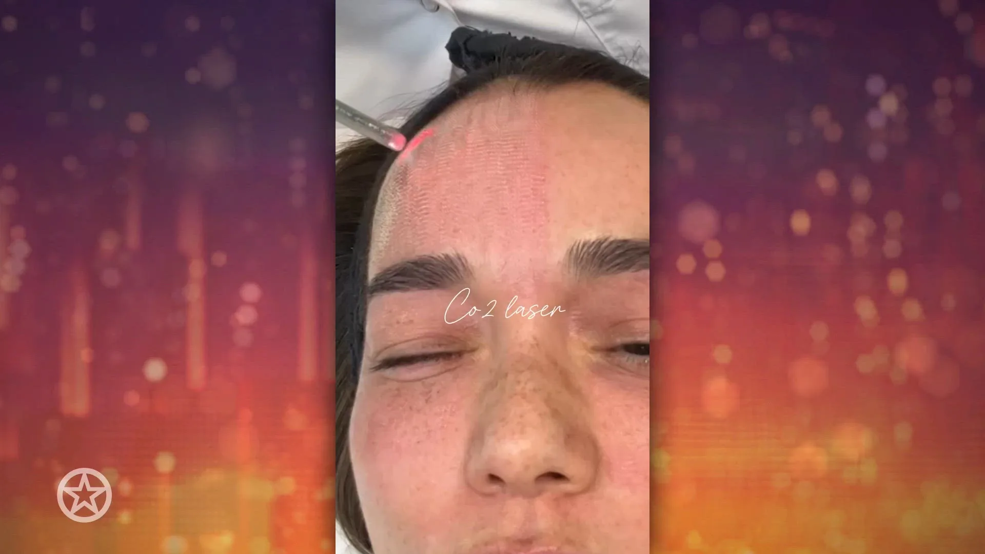 Bibi Breijman deelt littekenbehandeling