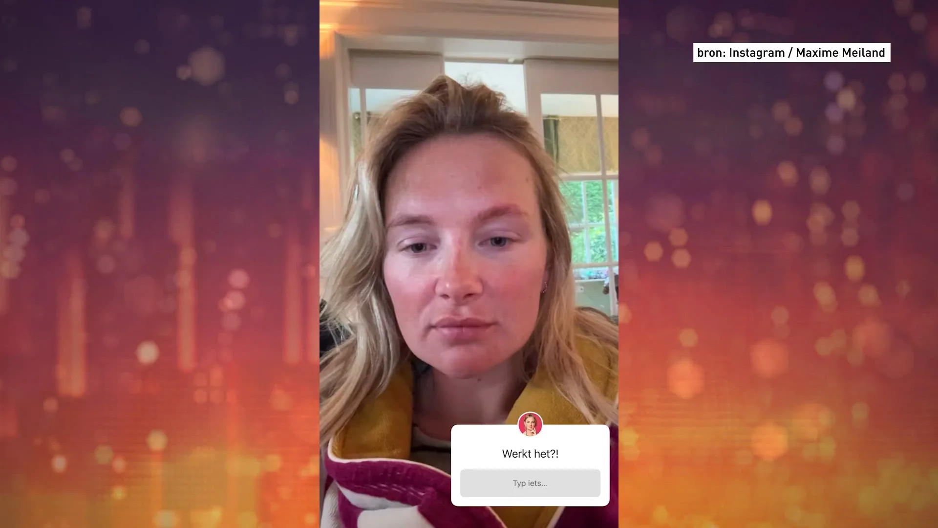 Maxime Meiland wil injecties voor dikker haar