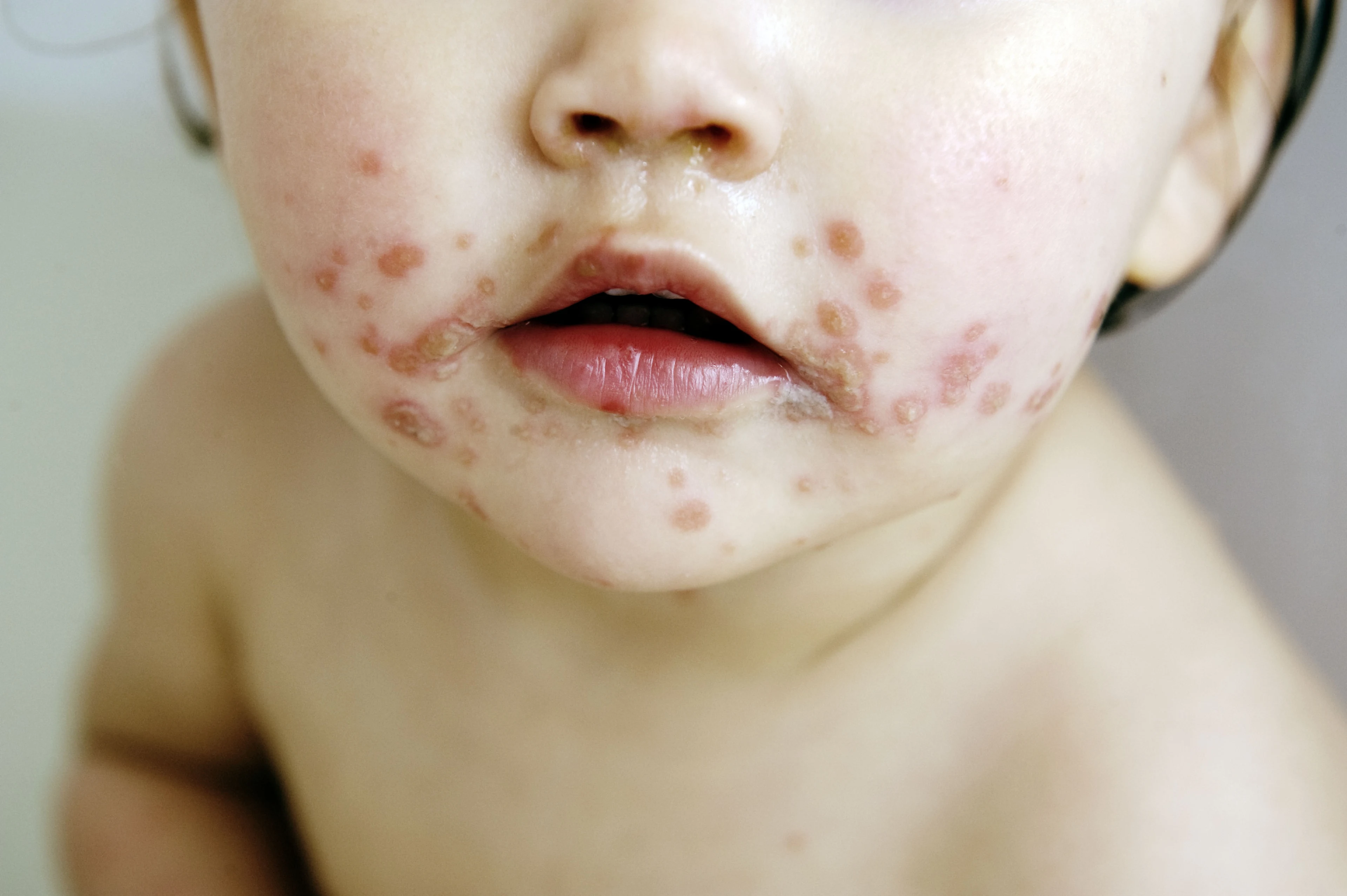 Grote toename waterpokken onder kinderen, mogelijk 'inhaaleffect' na corona