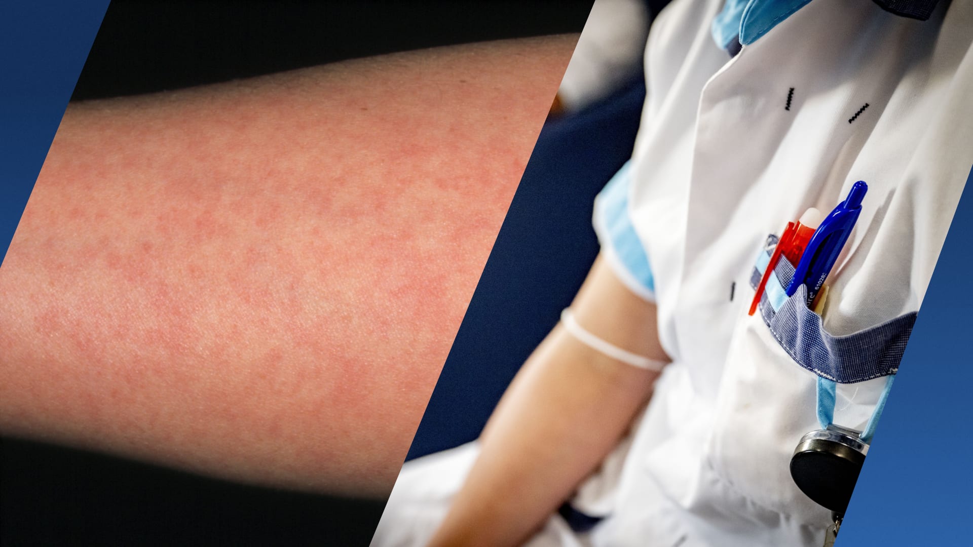 Nu al meer mazelenbesmettingen dan vorig jaar: dit is de oorzaak