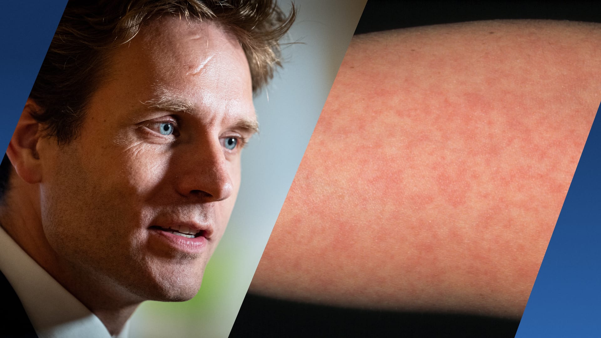 Zorgen bij staatssecretaris over oprukkende ziekten: 'Het gaat echt niet goed'