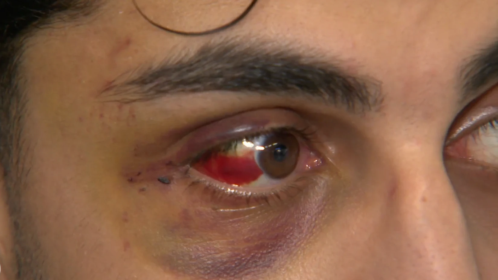 In elkaar geschopte Baz (19) terug uit Chersonissos: 'Ik had dood kunnen zijn'