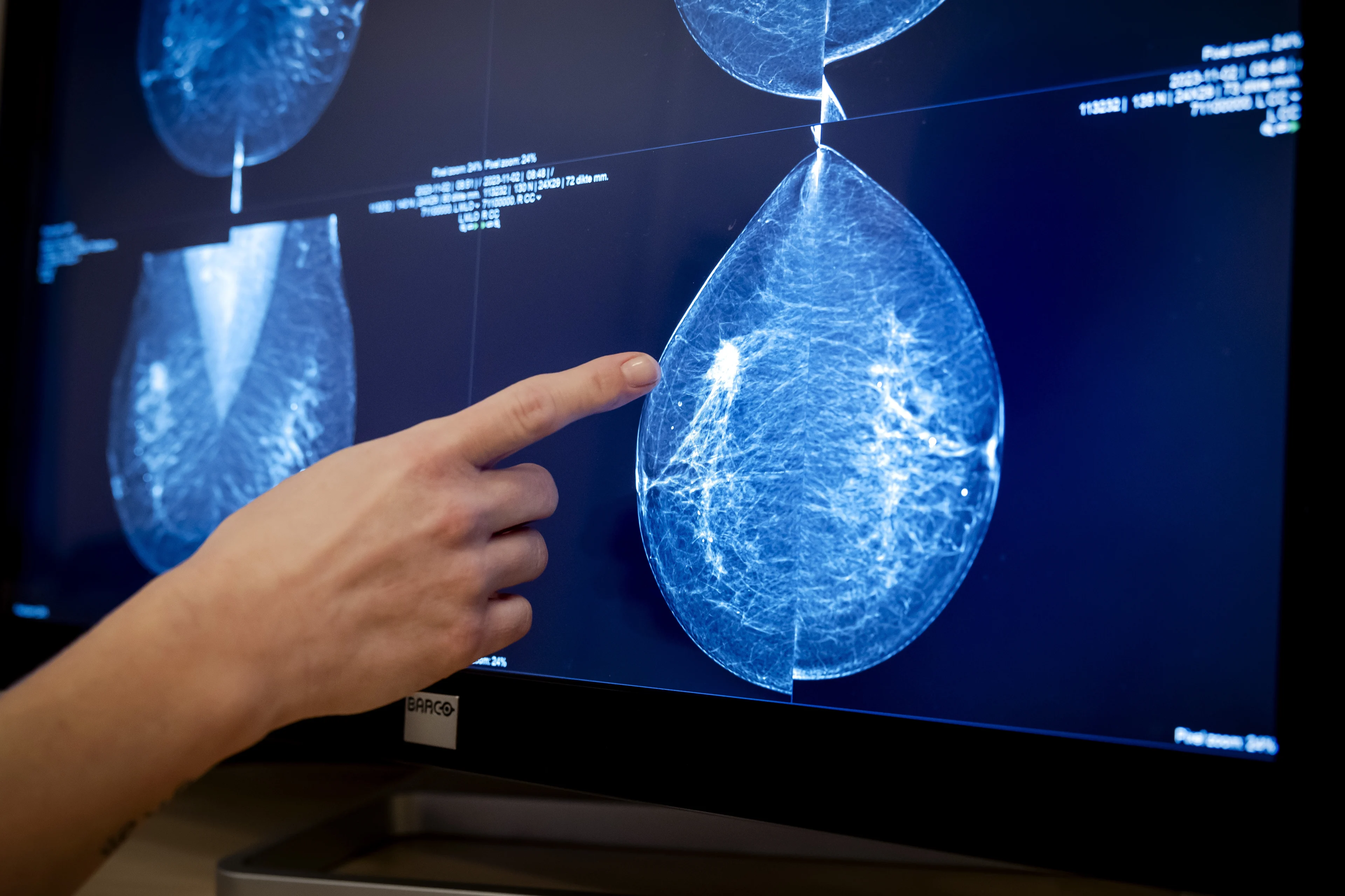 Borstkankermedicijn Trodelvy toch opgenomen in basisverzekering