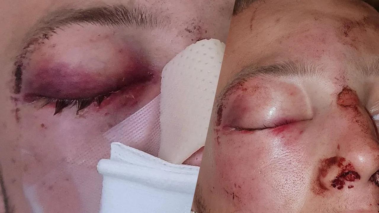 Raymond (21) in gezicht geschopt en geslagen bij Drentse zwemplas: 'Hij kan amper praten'