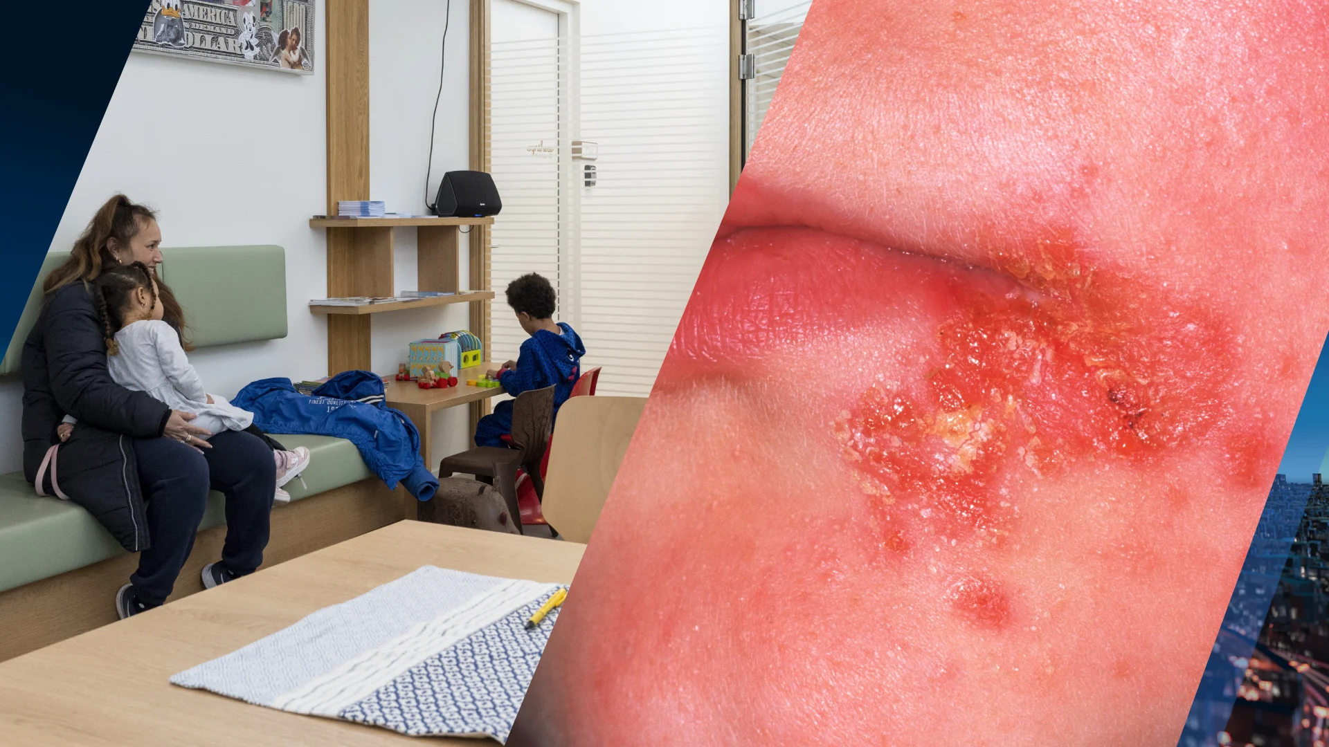 Krentenbaard grijpt om zich heen bij kinderen: flinke piek in huisartsbezoeken