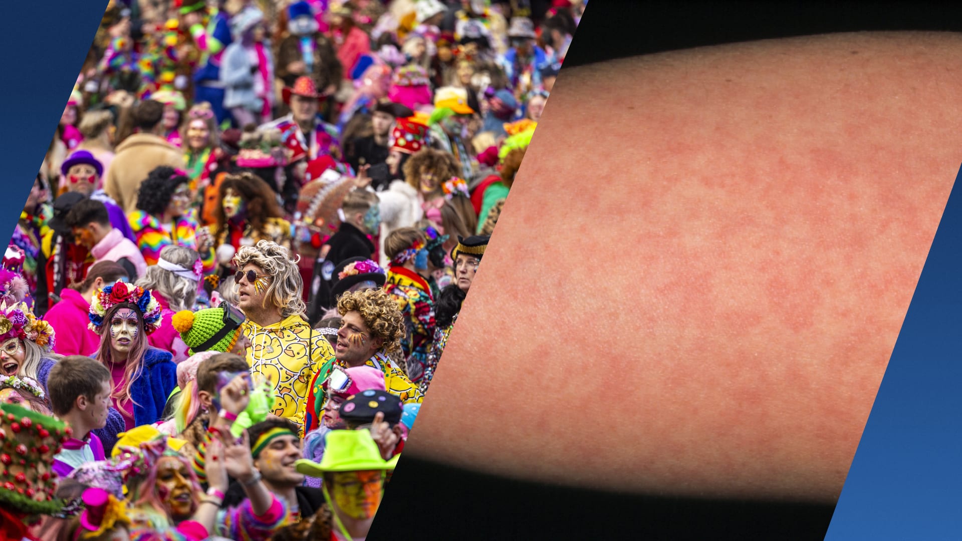 Mazelenuitbraak vlak voor carnaval: 'Blijf thuis als je je niet lekker voelt'