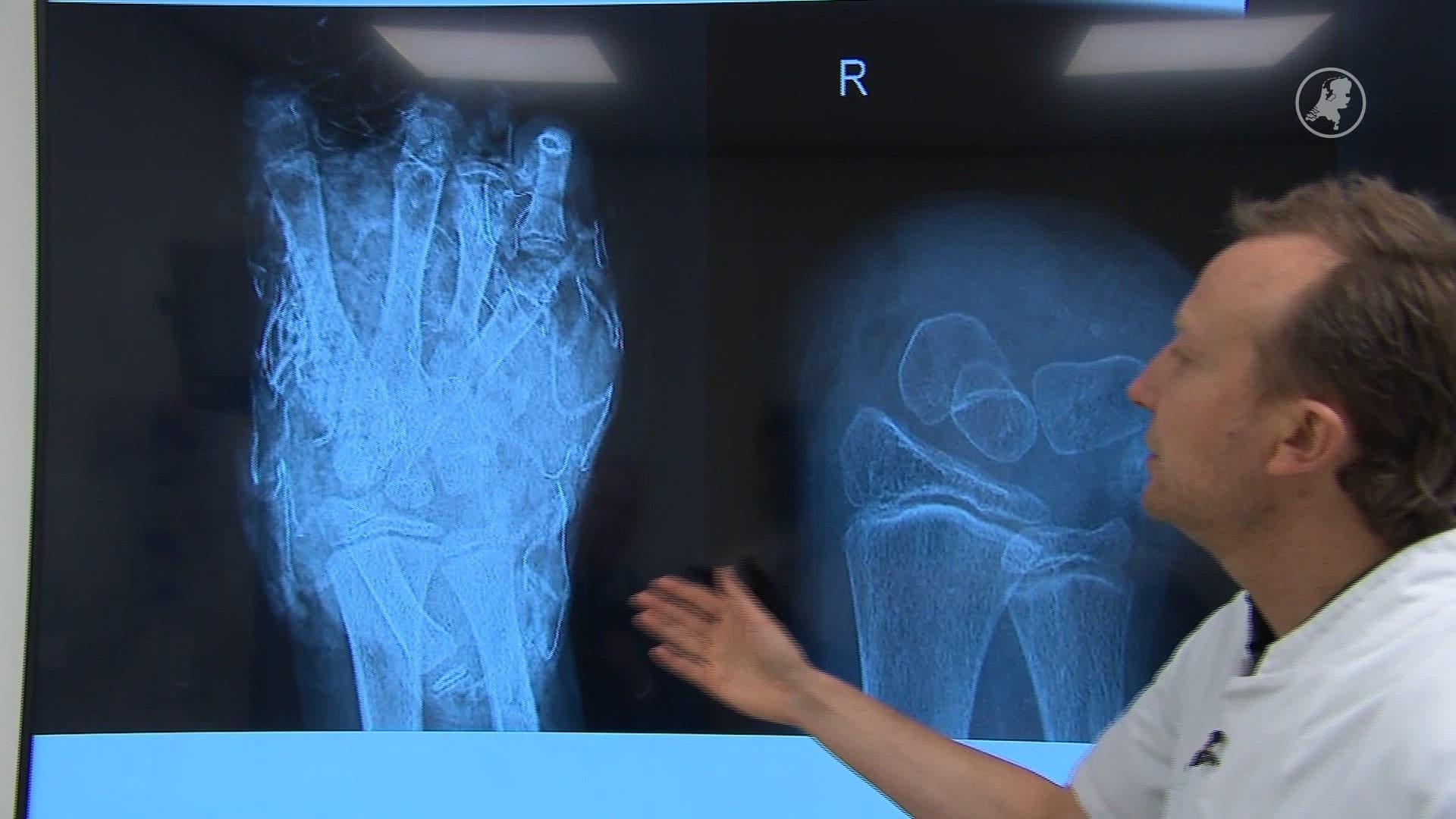Chirurgen waarschuwen voor illegaal zwaar Cobra 6-vuurwerk