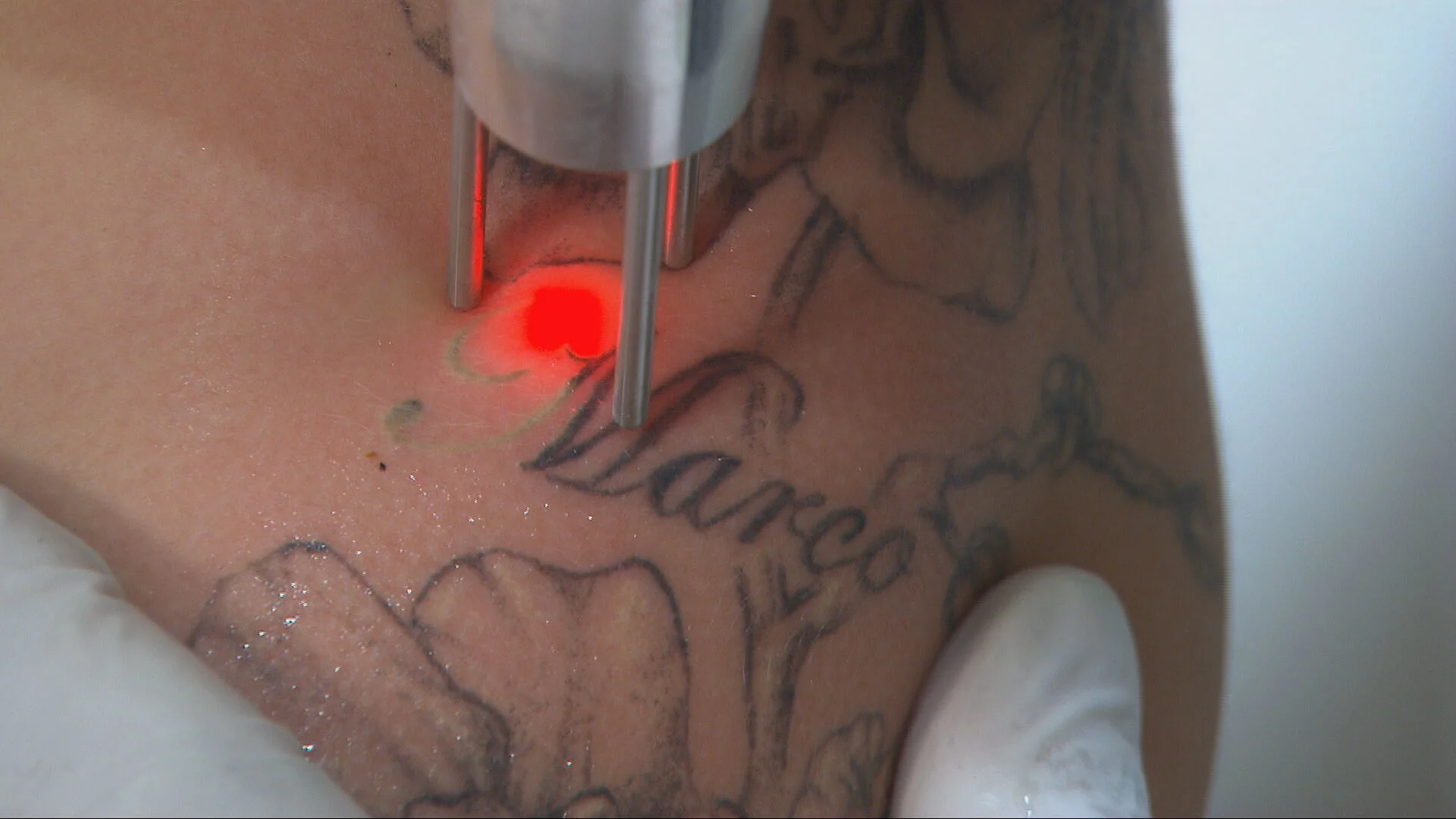 'Alarm om wildgroei tattooverwijdering: risico’s groot'