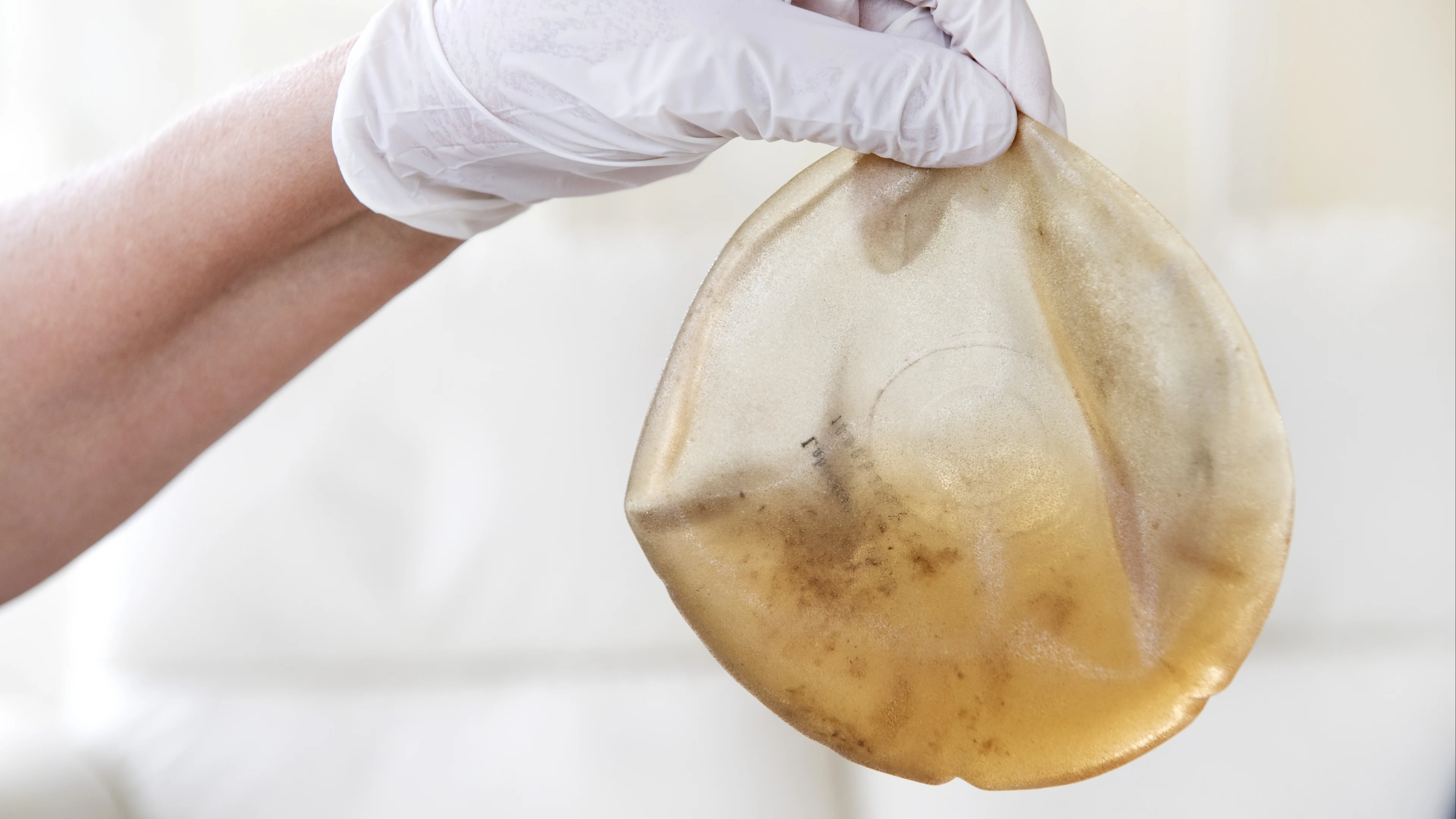 'Steeds meer vrouwen laten borstimplantaten verwijderen, angst voor risico’s'