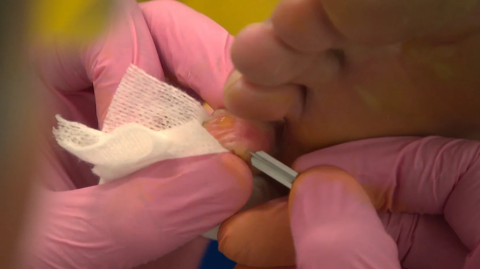 Blaren? Zo kom je er vanaf óf kan je ze voorkomen