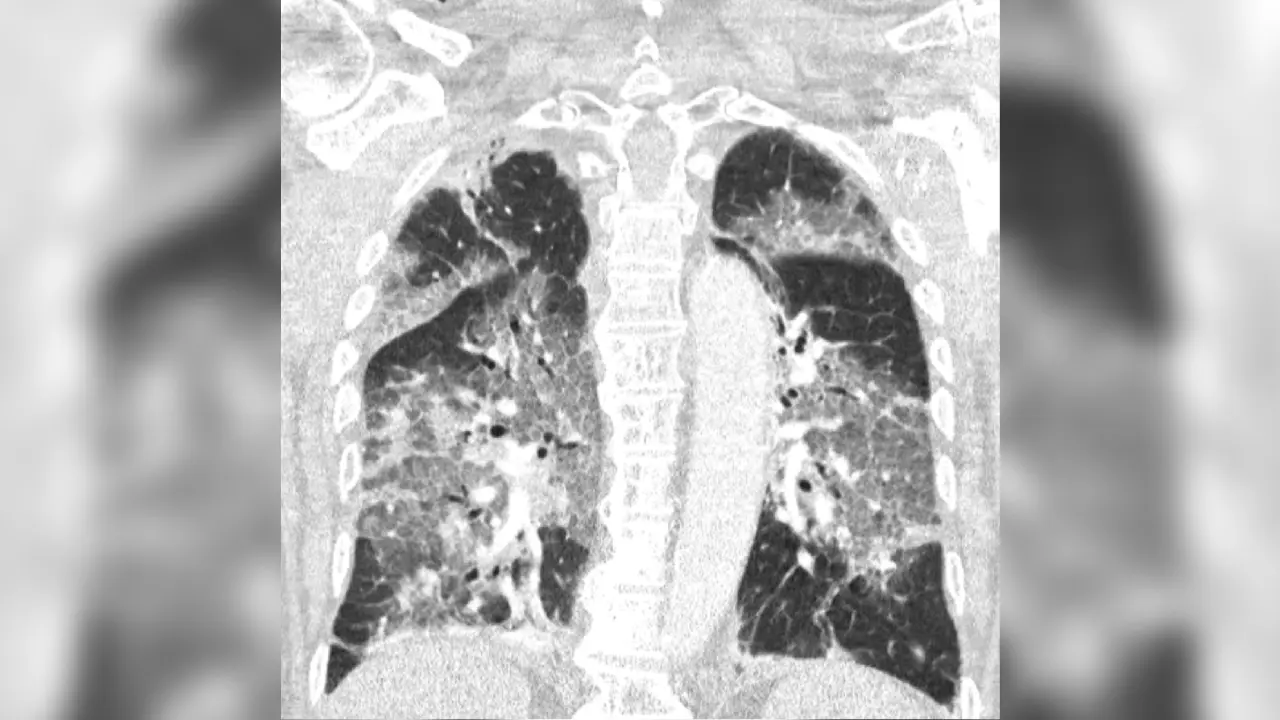 Ziekenhuis deelt longfoto van man die AstraZeneca weigerde en heel ziek werd