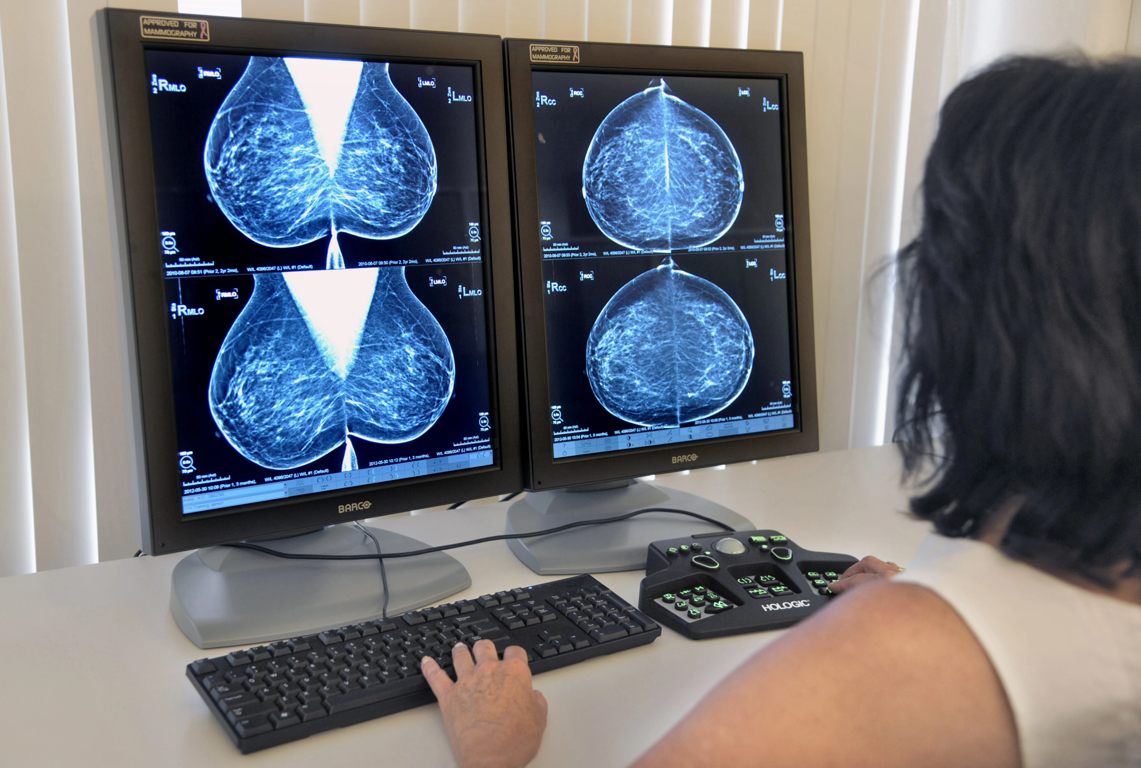 'Aanbieders promoten onbetrouwbaar borstonderzoek als kankerscreening'