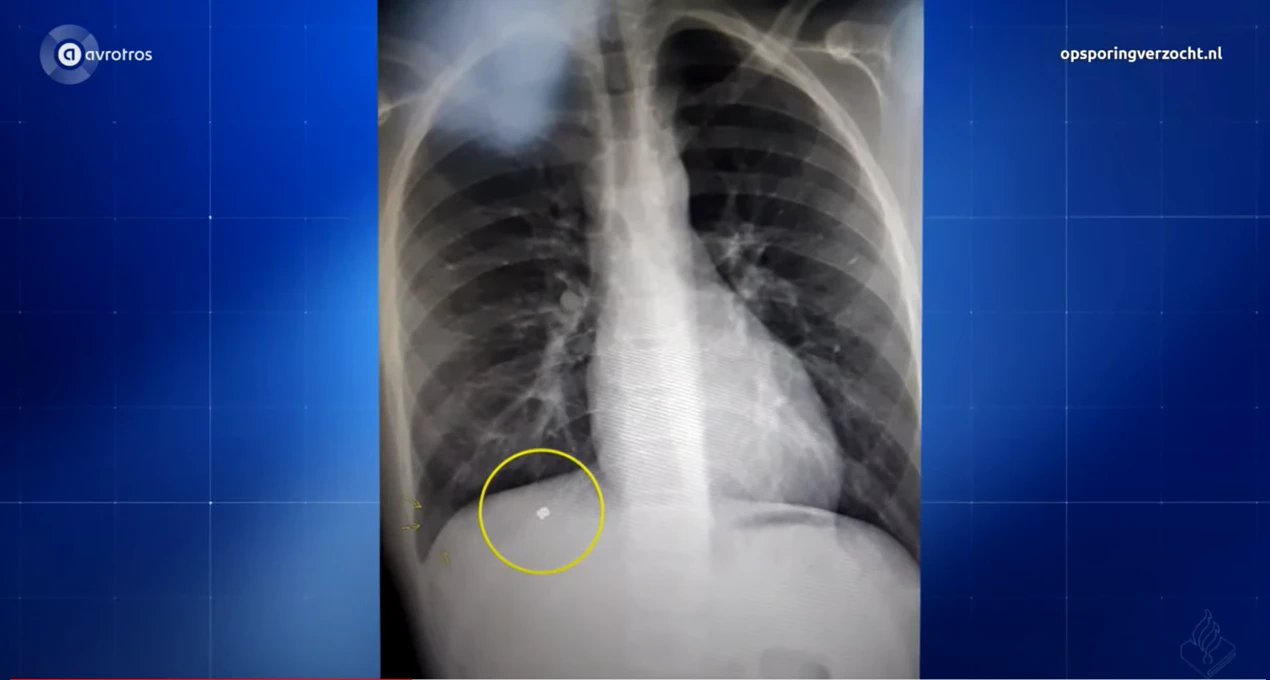 Beschoten jongen (13) uit Barneveld moet voor altijd leven met een kogel in zijn lichaam