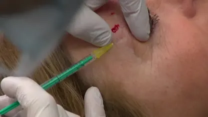 Naar de tandarts voor een spuitje botox: Goed idee of wachten tot het fout gaat?